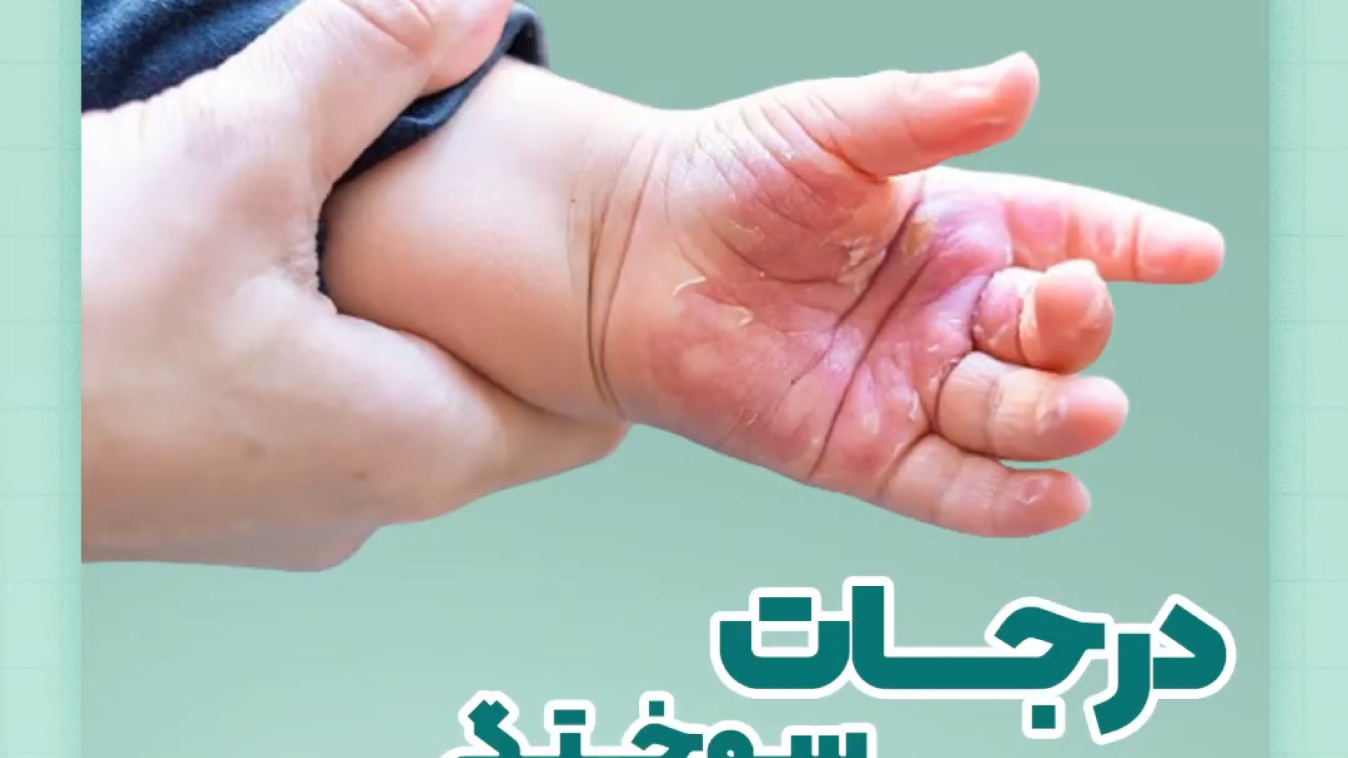 درجات سوختگی در کودکان لیزر فرکشنال