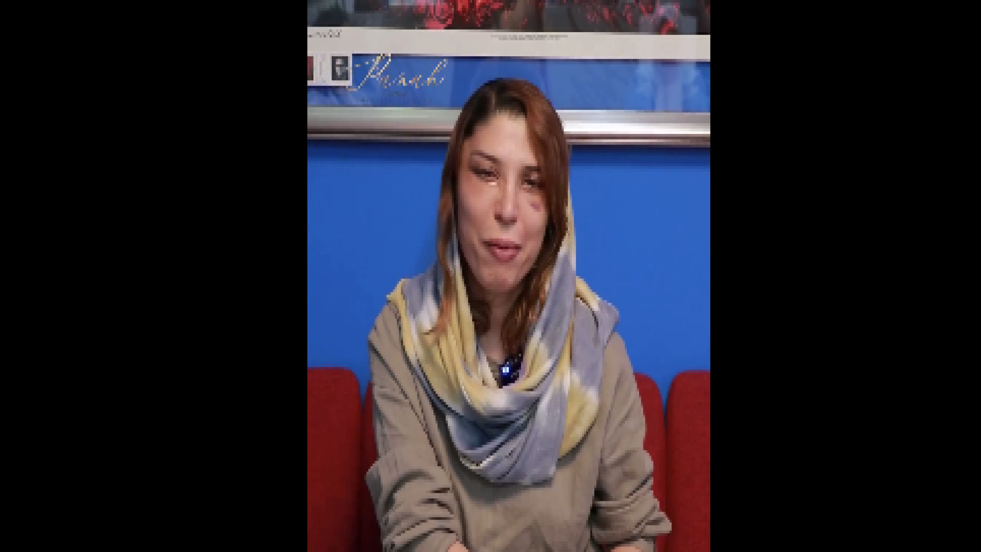 لیفت شقیقه وگونه همراه با بلفاروپلاستی دکتر حسین پناه