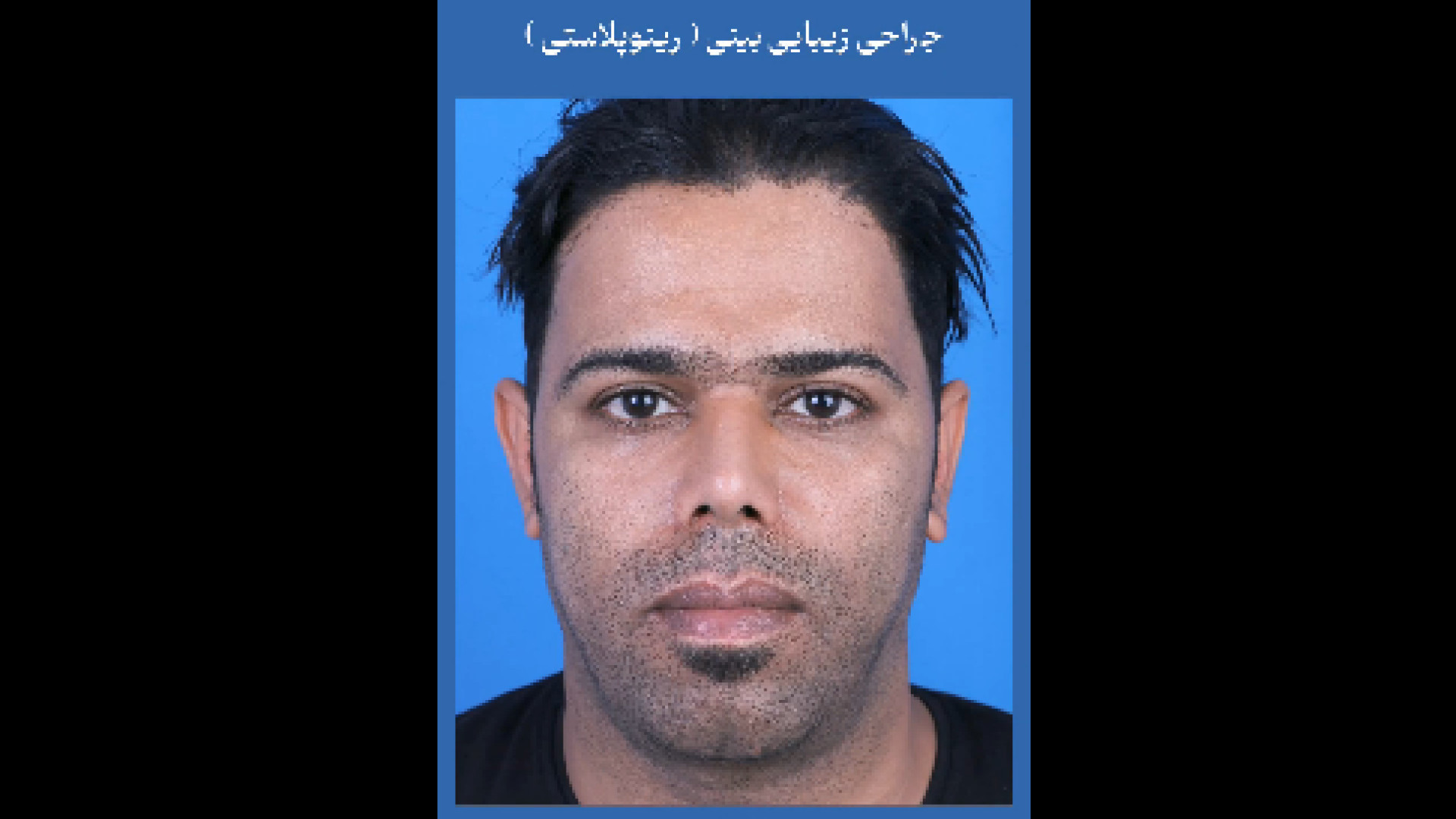 6 مـاه پـس از جـراحـی زیبـایی بـینـی دکتر فردوس مذنبی