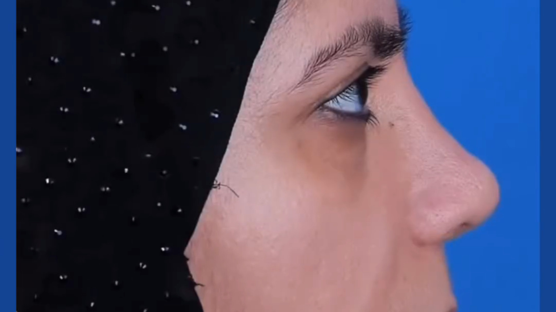 قبل و بعد رینوپلاستی دکتر فردوس مذنبی