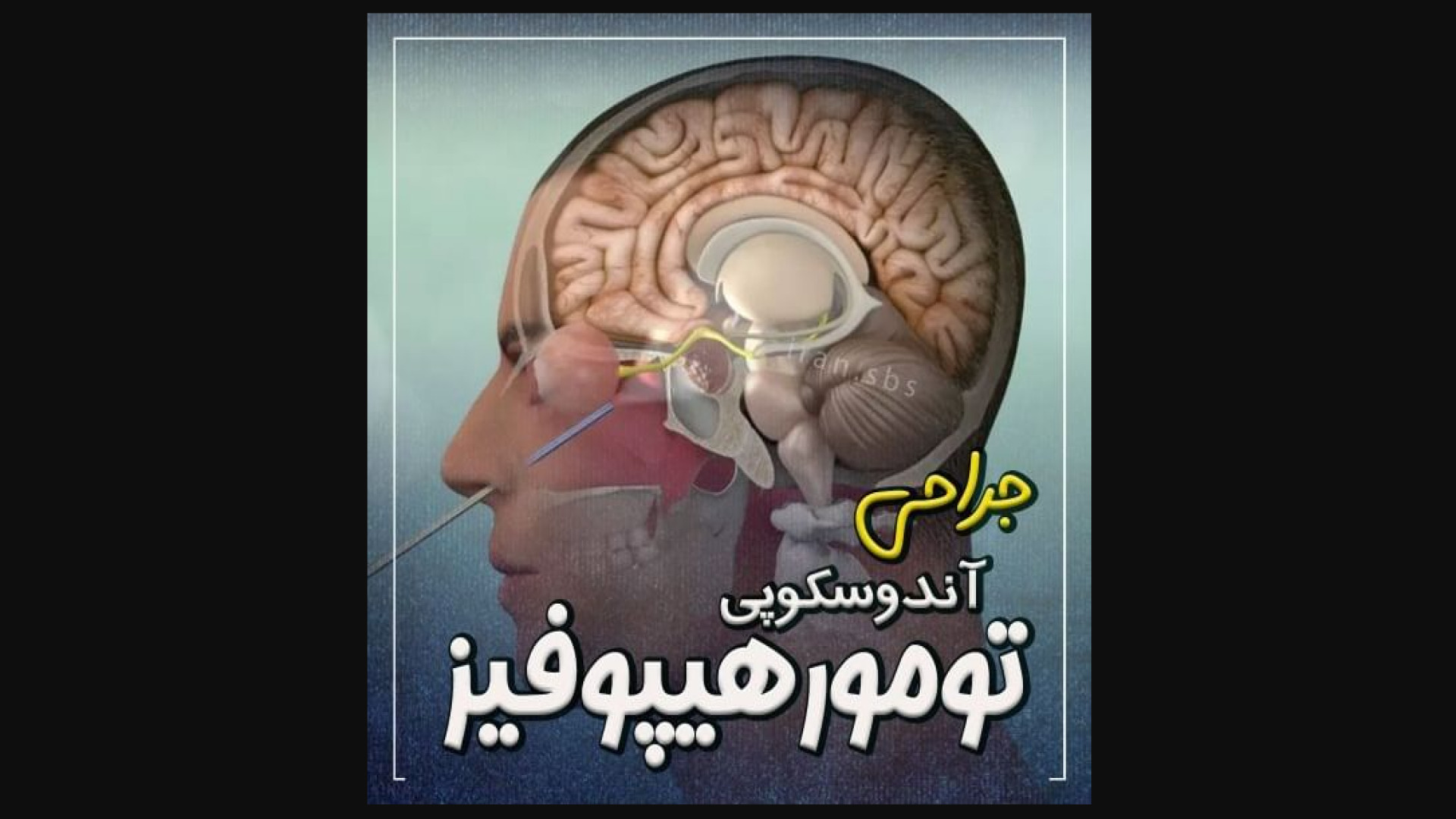 جراحی آندوسکوپی تومور هیپوفیز پر کردن دندان