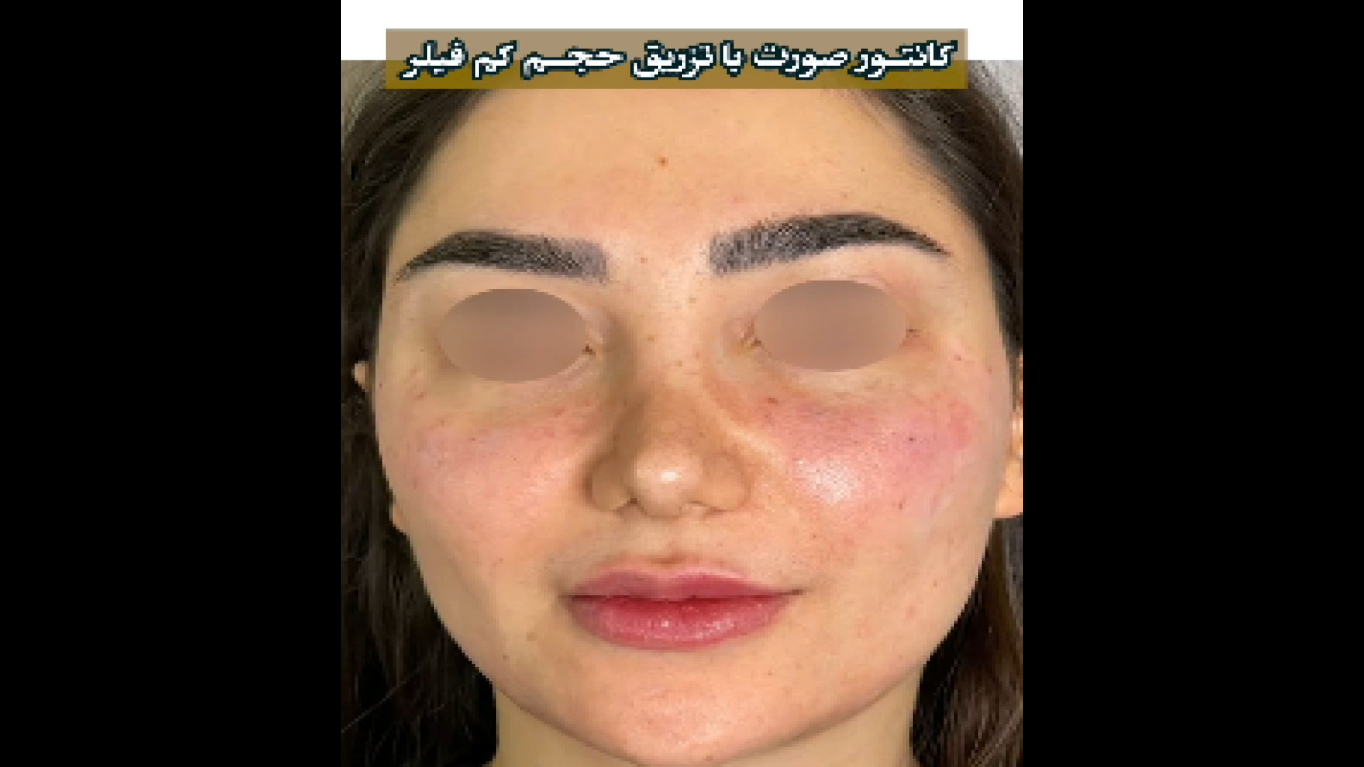کانتور صورت با تزریق حجم کم فیلر دکتر بهناز همدانی - متخصص پوست، مو و زیبایی