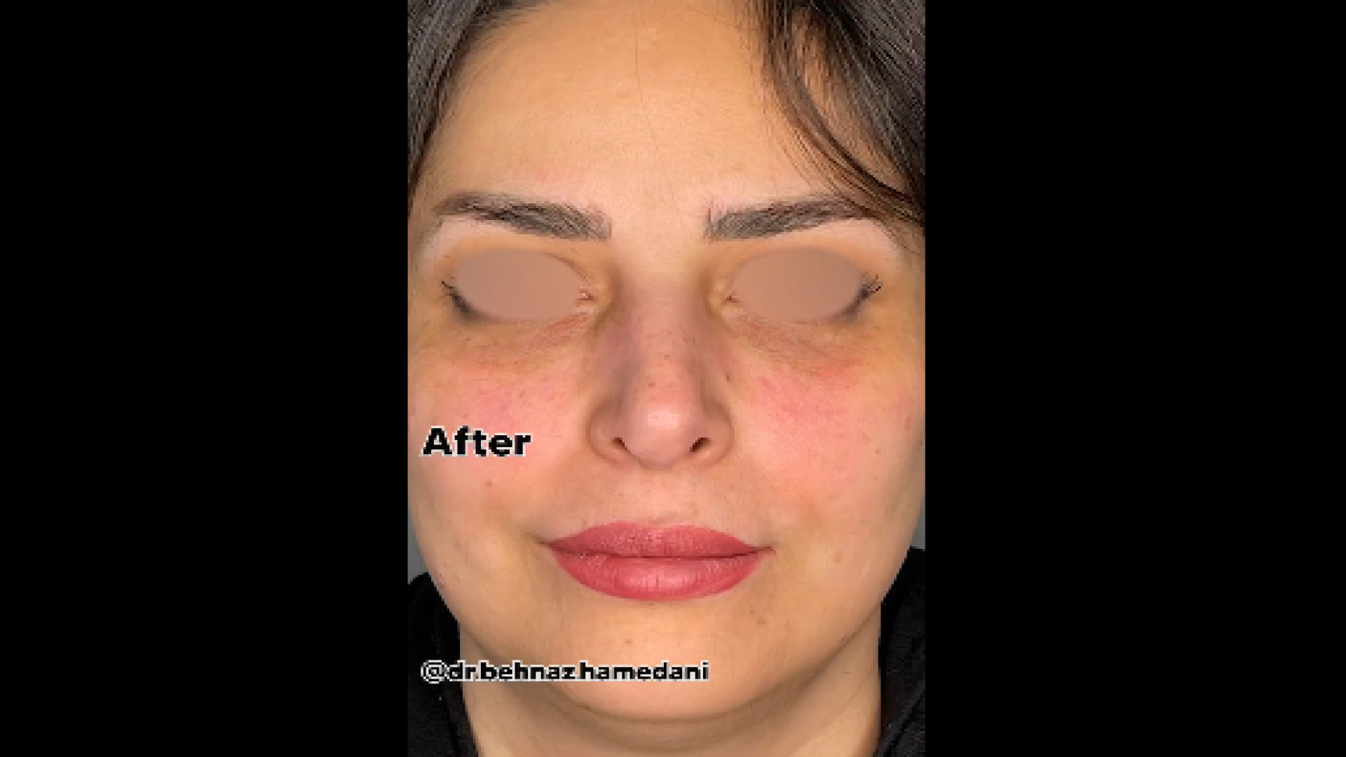 جوانسازی زیر چشم با تزریق فیلر دکتر بهناز همدانی - متخصص پوست، مو و زیبایی