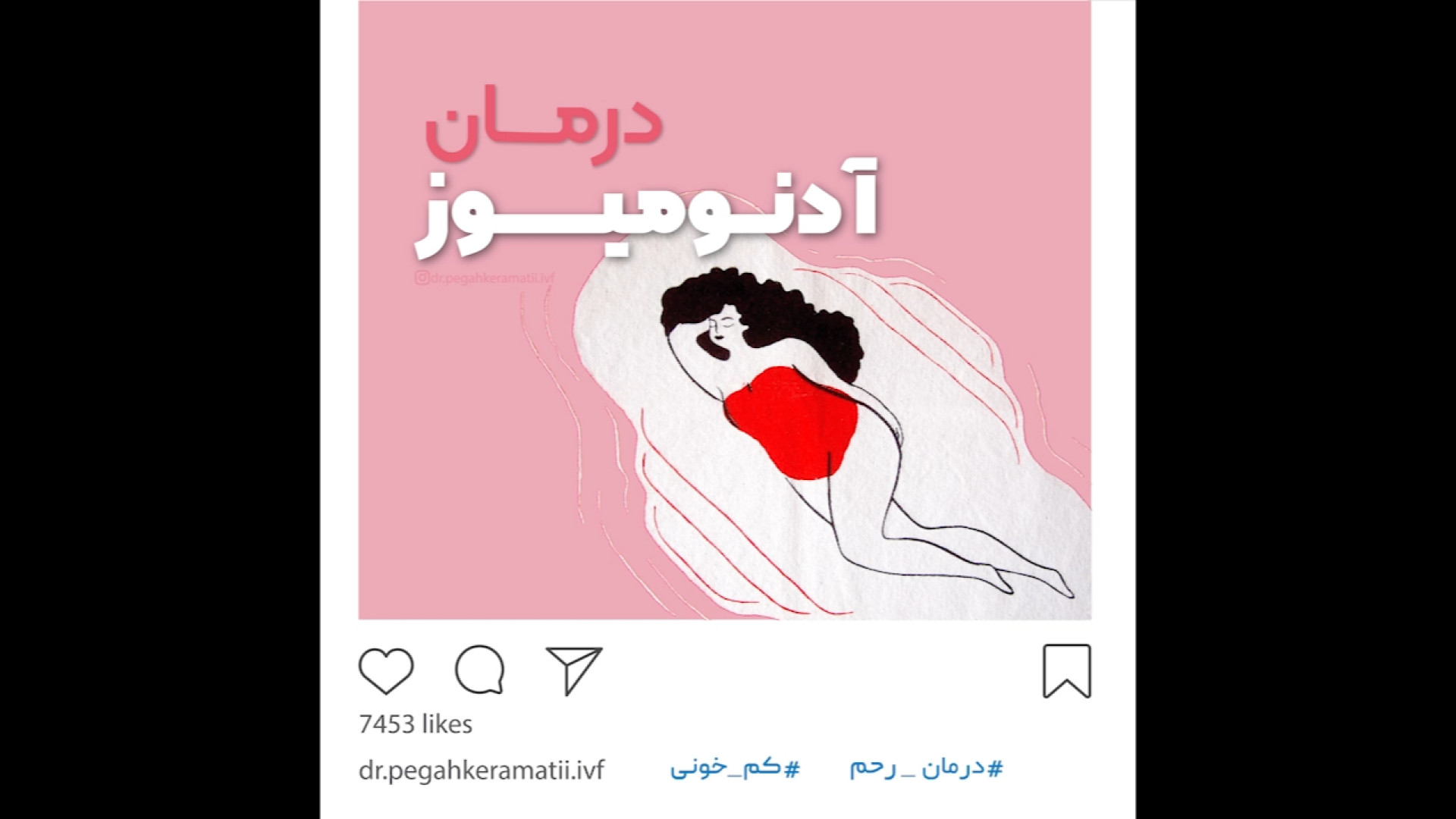 آندومتریوز ماموپلاستی