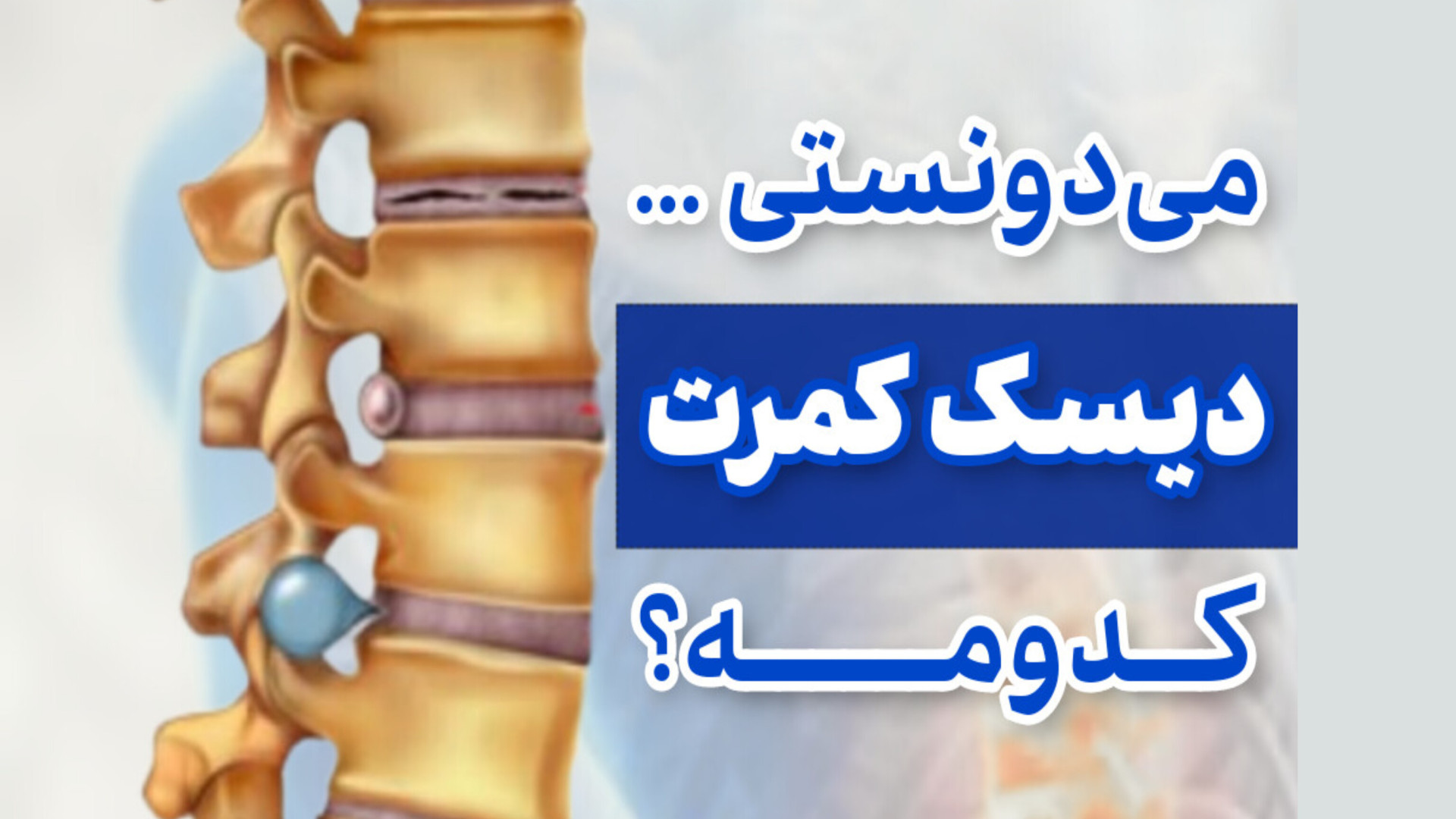 دیسک کمرت کدومه؟ دکتر محمود جعفر بیگلو