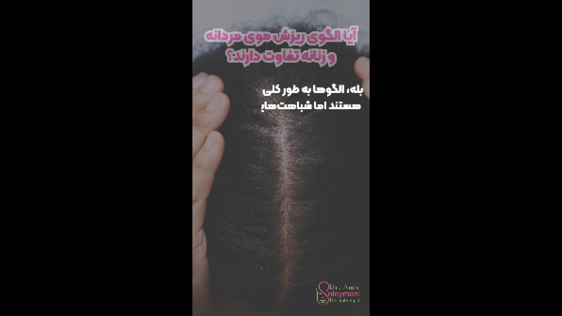 الگوی ریزش و موی زنان و مردان دکتر امیر سلیمانی