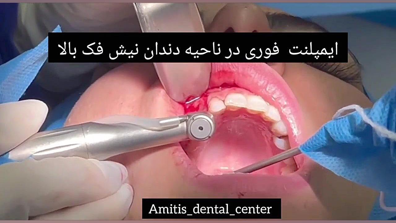 ایمپلنت فوری دندان نیش فک بالا RNA Interference Assay