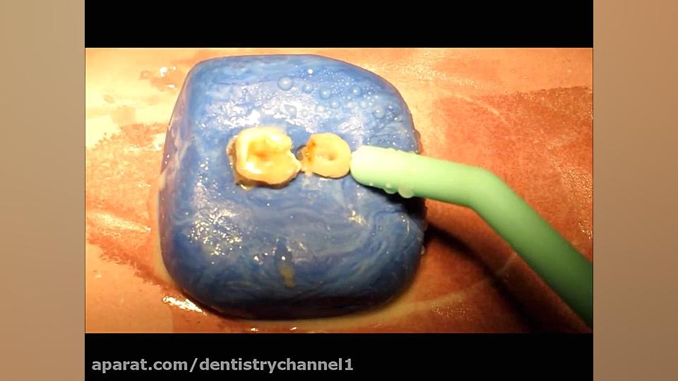 آماده سازی حفره برای پالپوتومی ژنراتور پالس عصبی