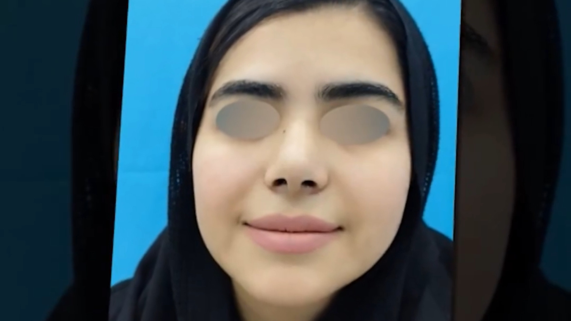 یک ماه بعداز جراحی بینی دکتر علی جمشیدی