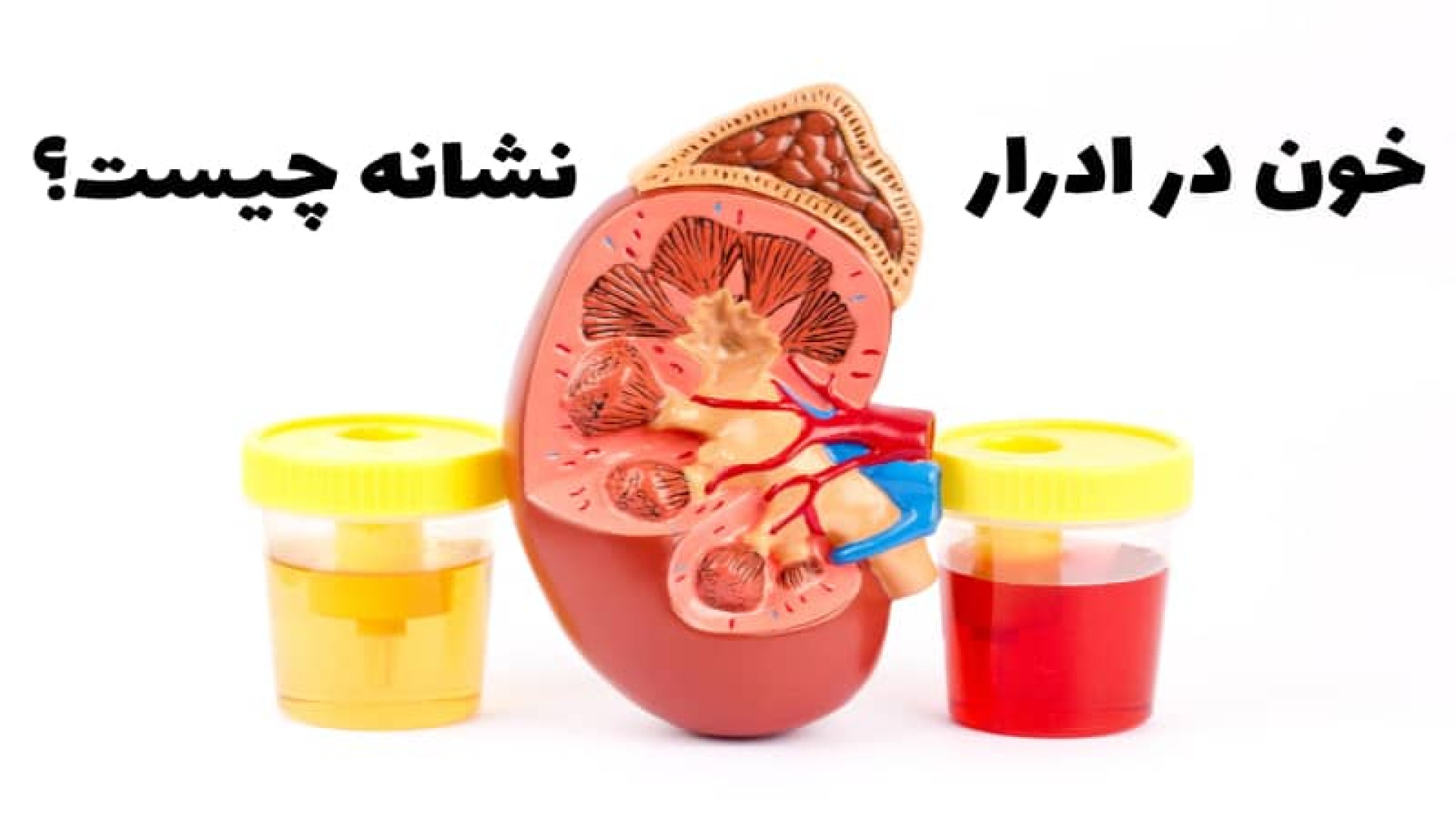 خون در ادرار یا ادرار خونی|دکترخیام فرفوق تخصص اورولوژی احمدرضا عابدزاده