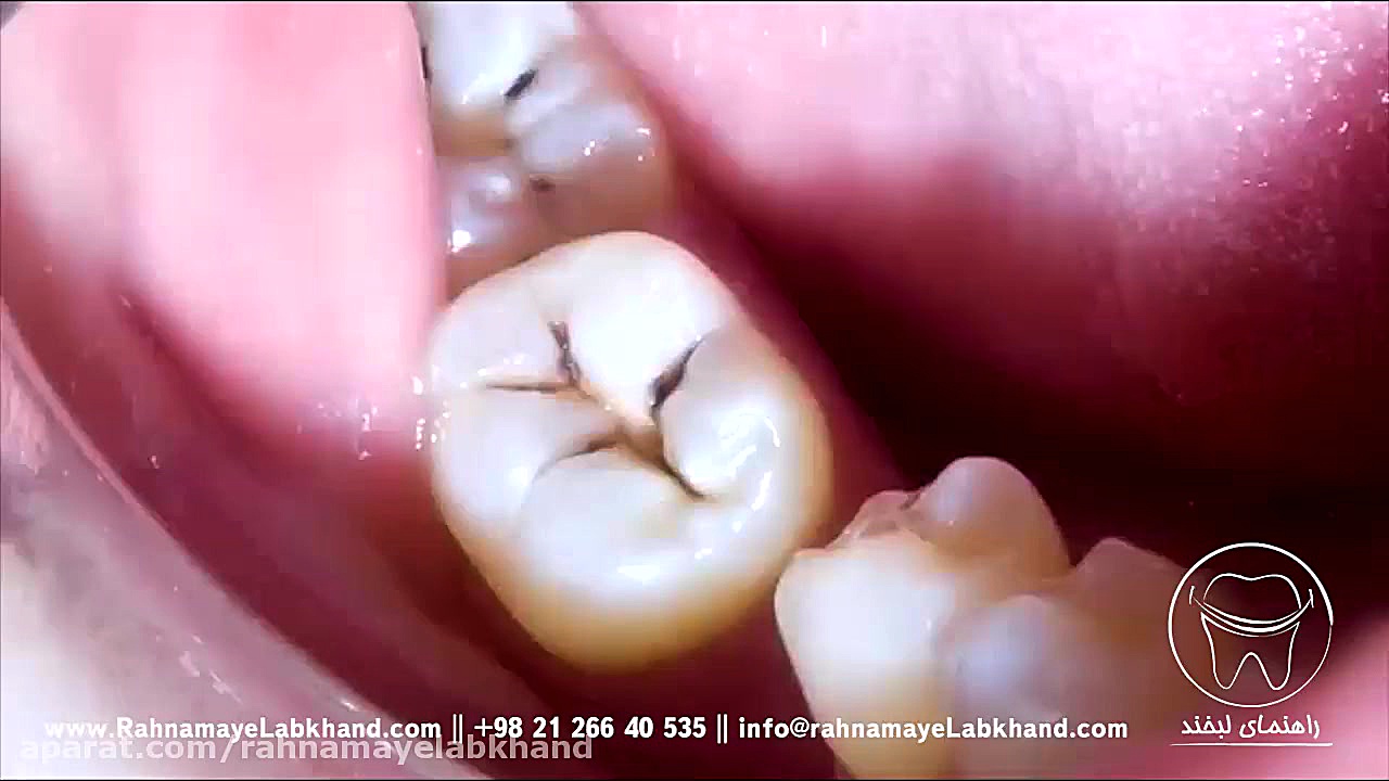 پر کردن دندان پلتفرم Drug Screening