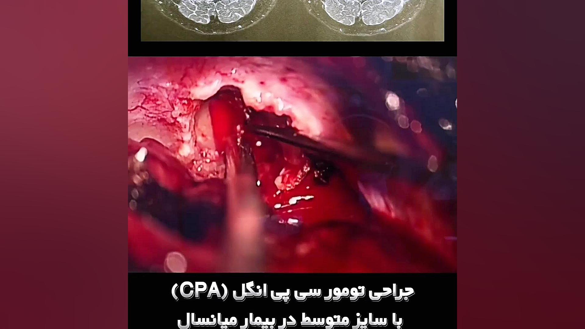 جراحی تومور سی پی انگل (CPA) با سایز متوسط در بیمار ۶۱ ساله کاشت مو