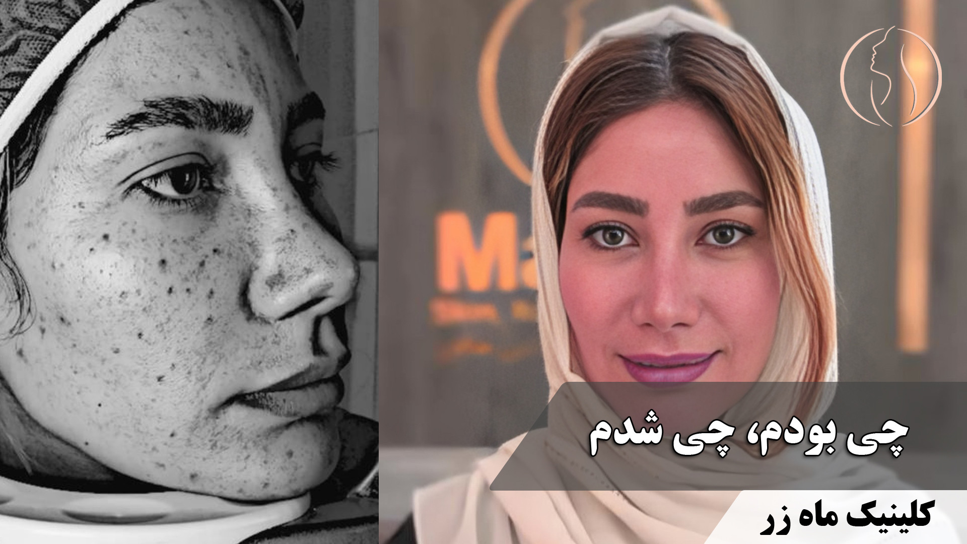 آیا لیزر اربیوم راه حل نهایی برای جای جوش است؟ ( کلینیک زیبایی ماه زر ) ابرسانی پوست