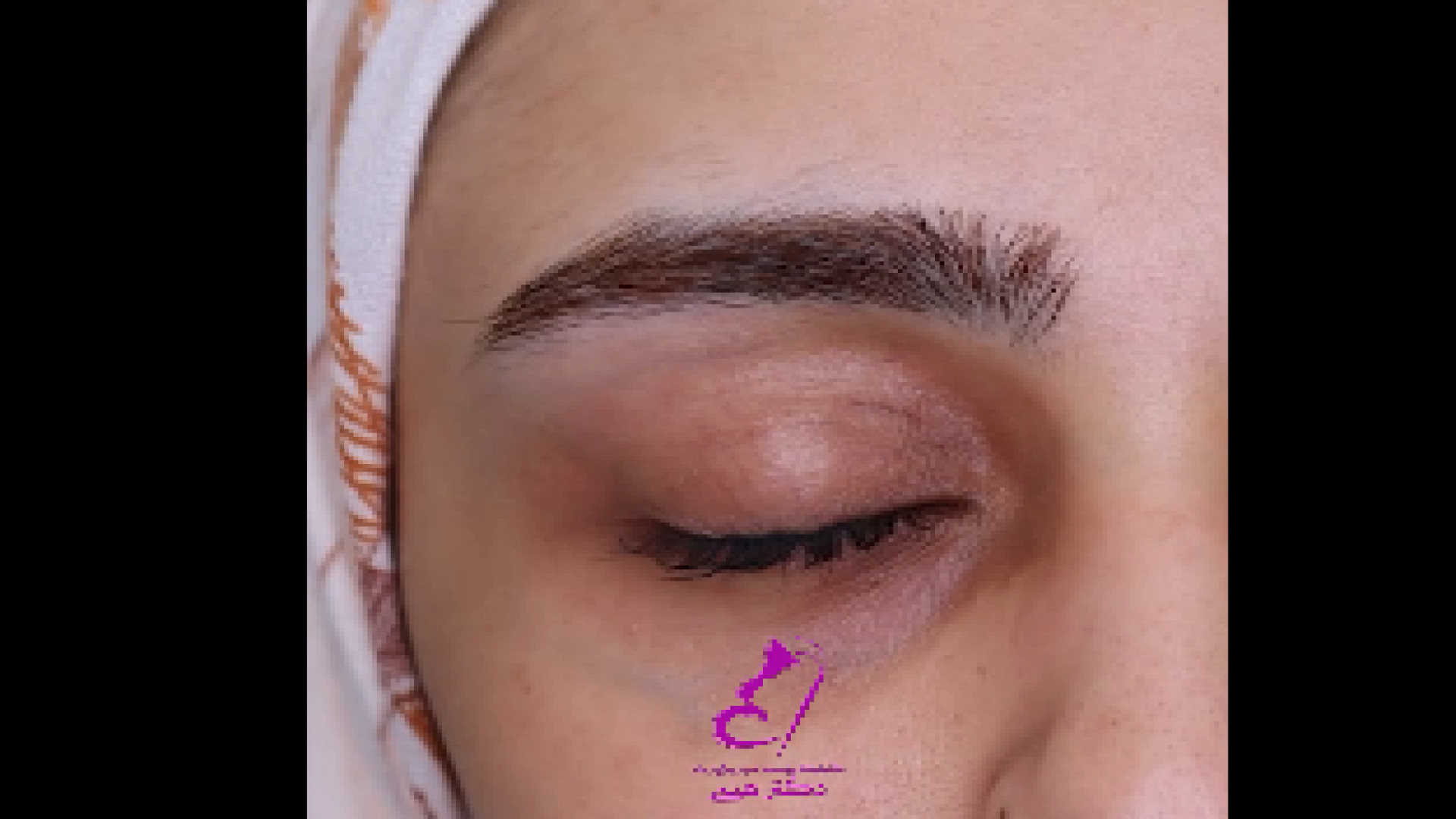 رفع تیرگی زیر چشم دکتر هدی عین اللهی