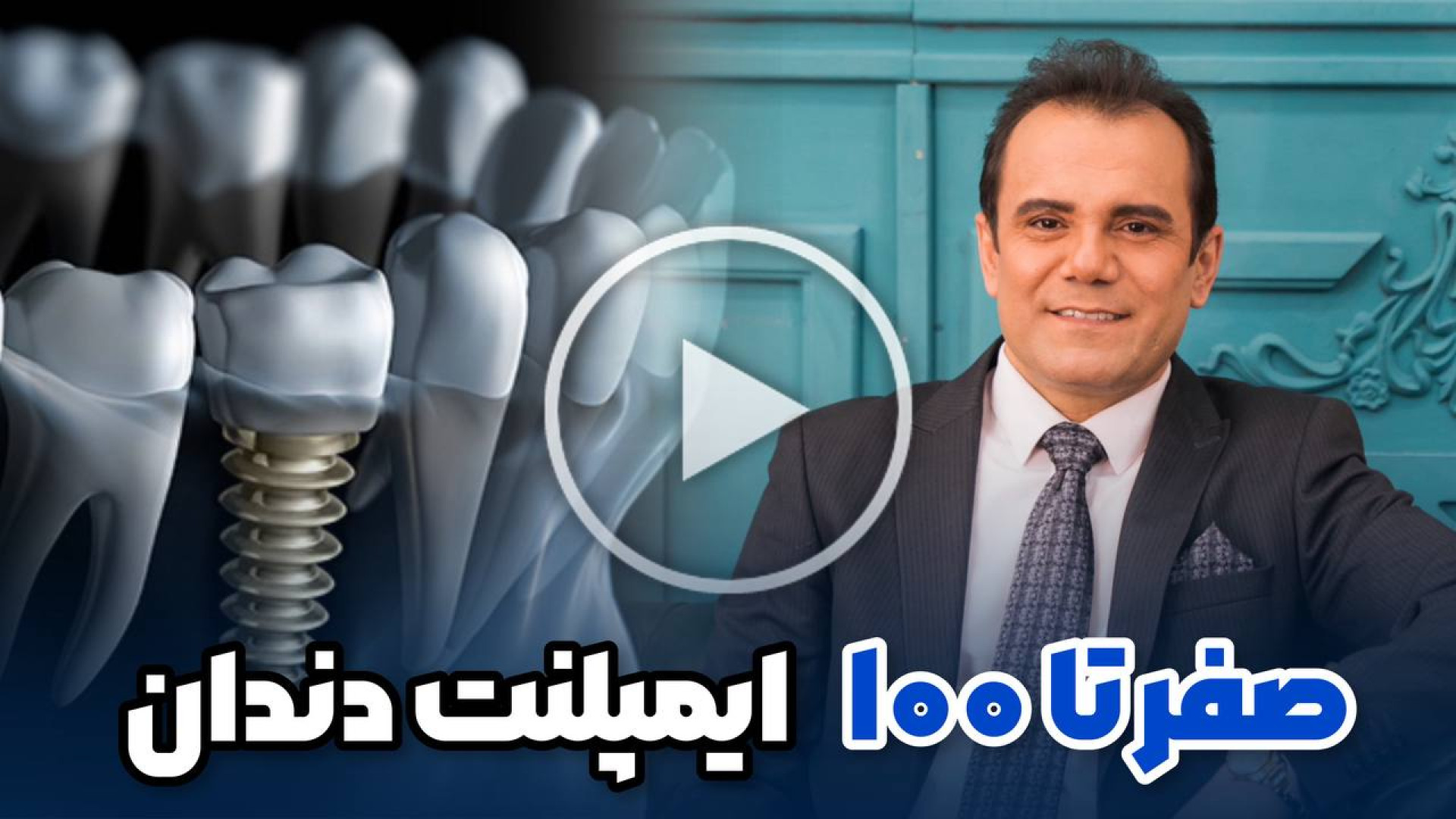 صفر تا صد ایمپلنت دندان دکتر عباس گشاده رو، متخصص جراحی لثه و ایمپلنت