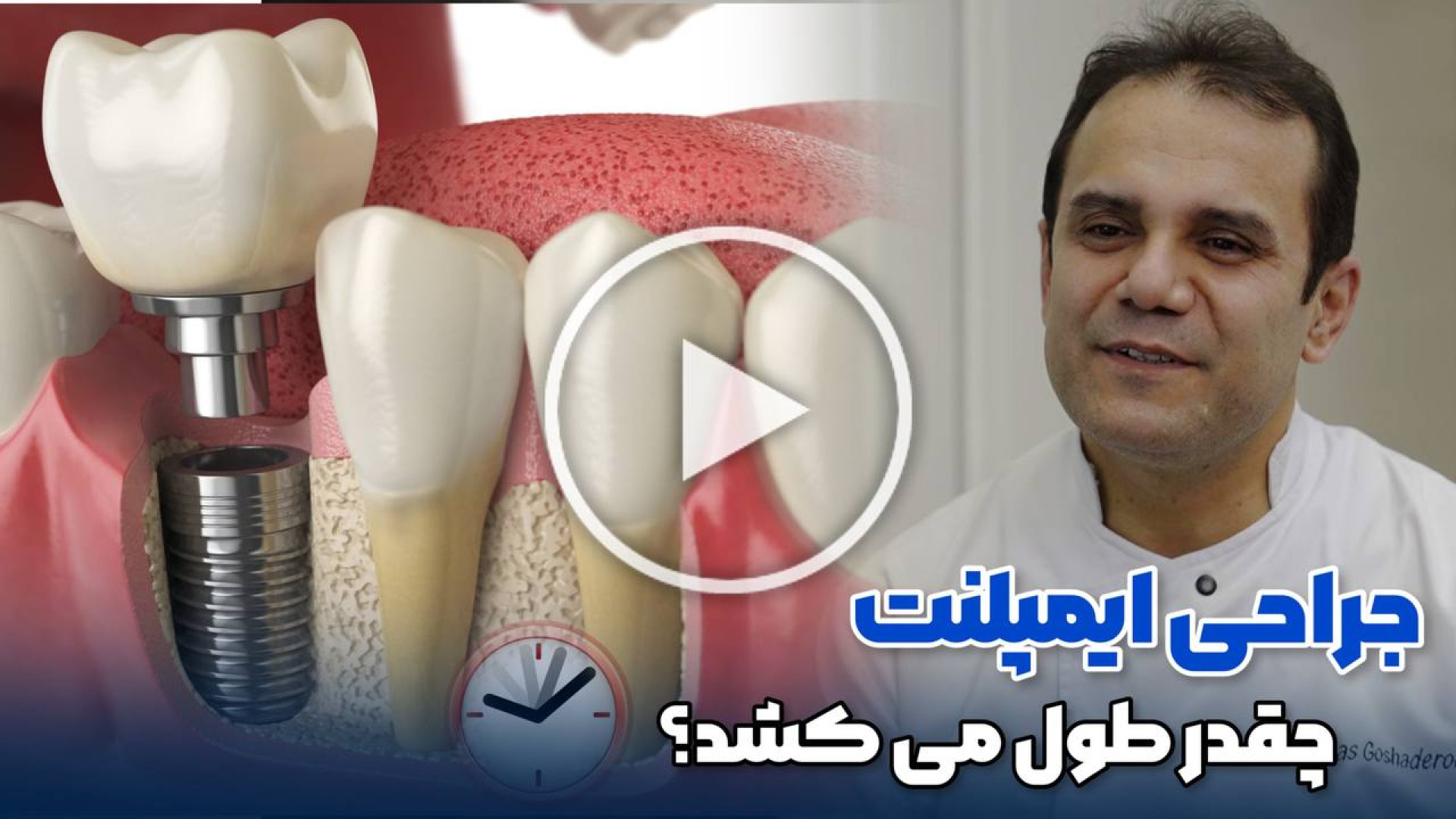 جراحی ایمپلنت چقدر طول میکشد میوکلونوس