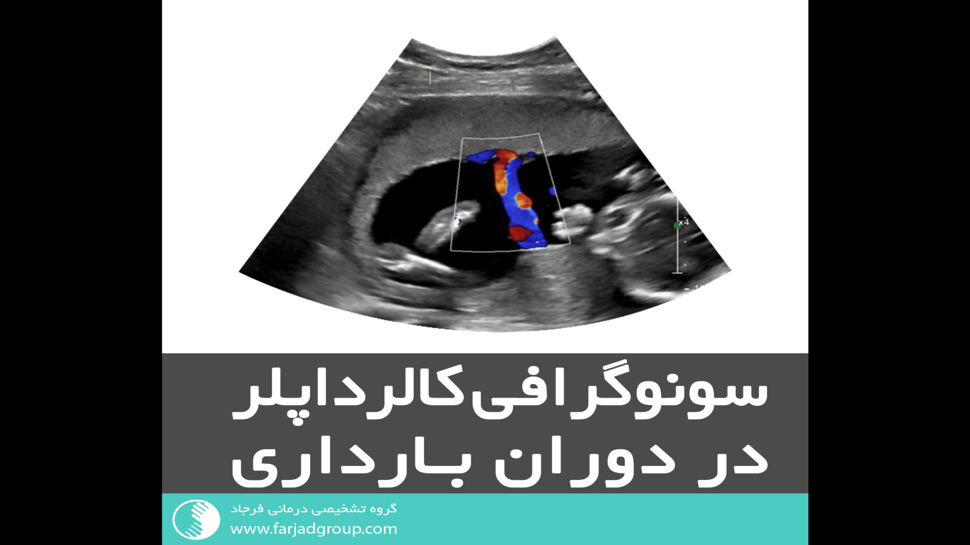 سونوگرافی کالرداپلر در دوران بارداری پوسیدگی دندان