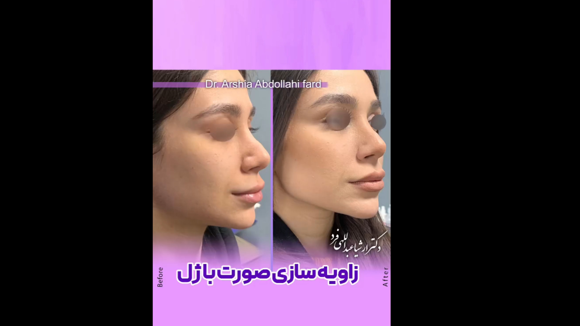 زاویه سازی صورت با تزریق ژل FEV1
