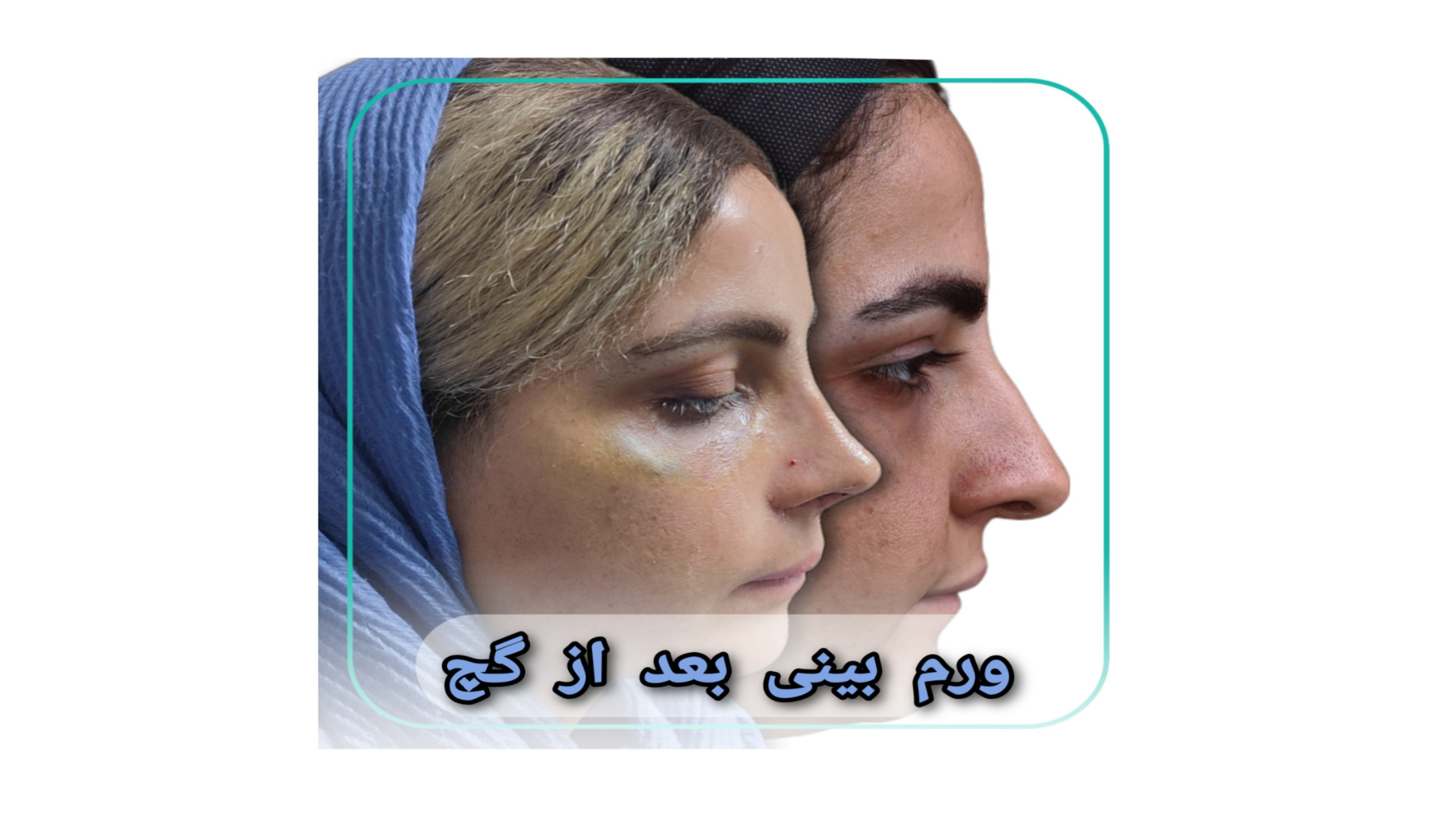 [بهترین جراح بینی تهران]{بهترین دکتر بینی تهران}دکتر محسن نوروزی نیا عمل جراحی زیبایی بینی-بدن(دکتر محسن نوروزی نیا)