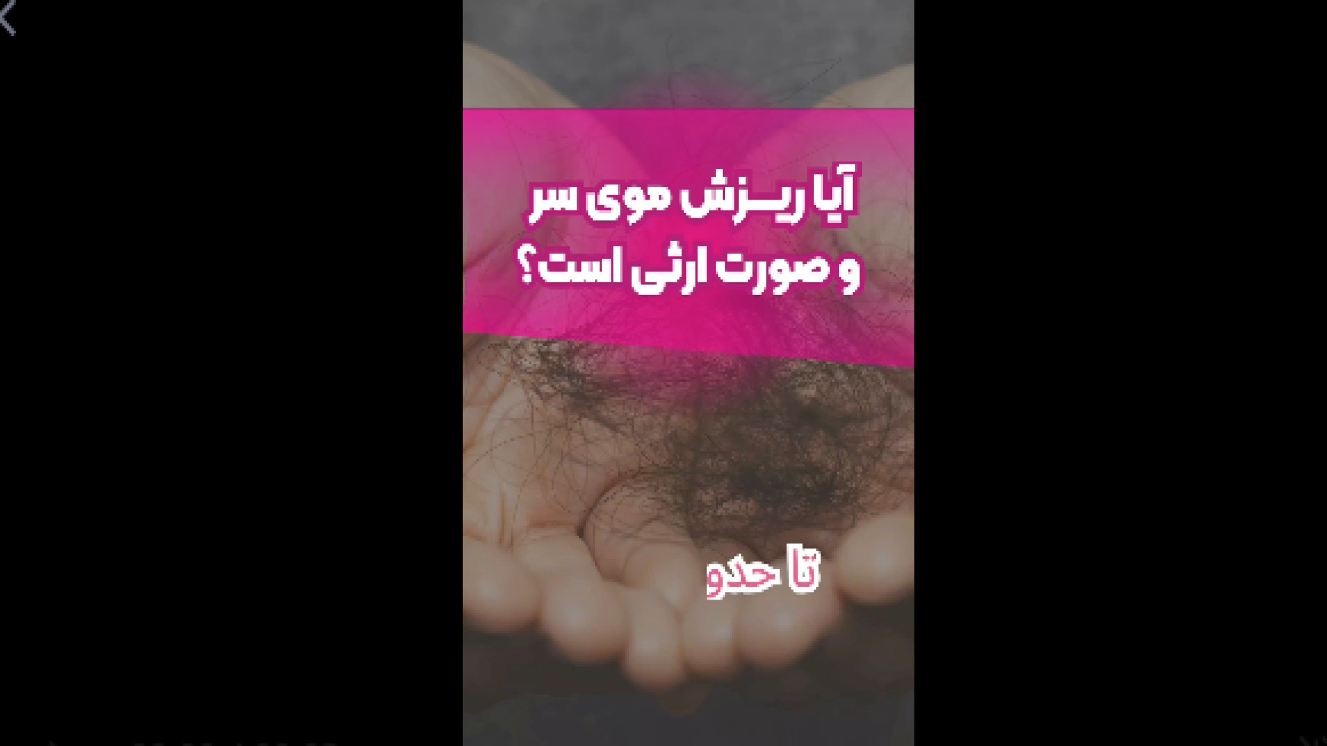 ریزش مو ارثی دکتر امیر سلیمانی