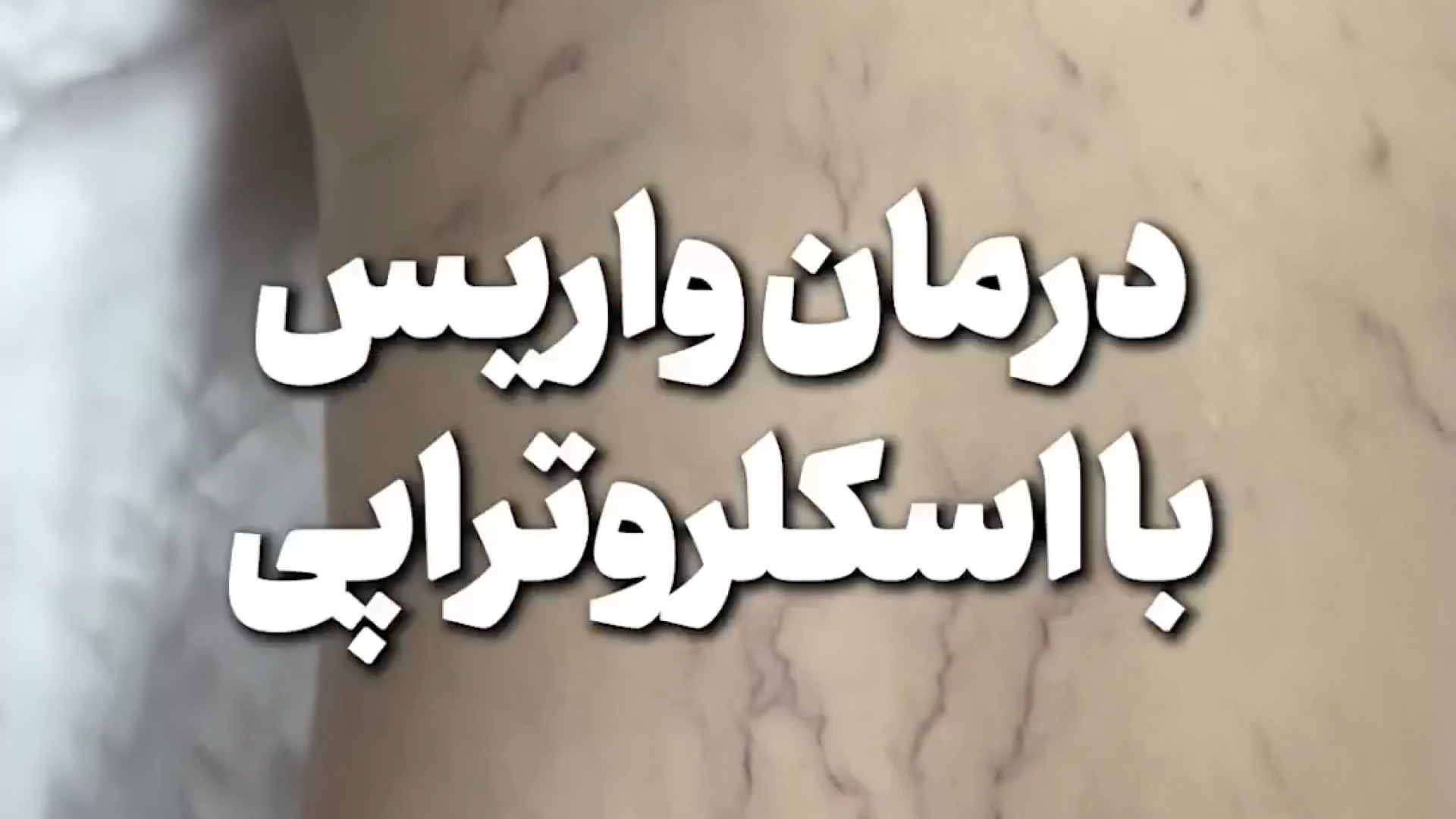 درمان واریس با اسکلروتراپی دکتر امیر سلیمانی