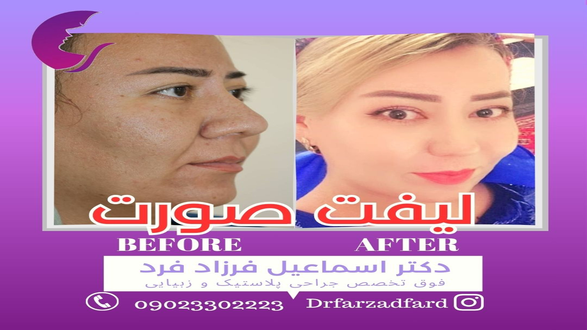 زیبا جوی عزیز از کشور ترکمنستان دکتر اسماعیل فرزاد فرد - فوق تخصص پلاستیک