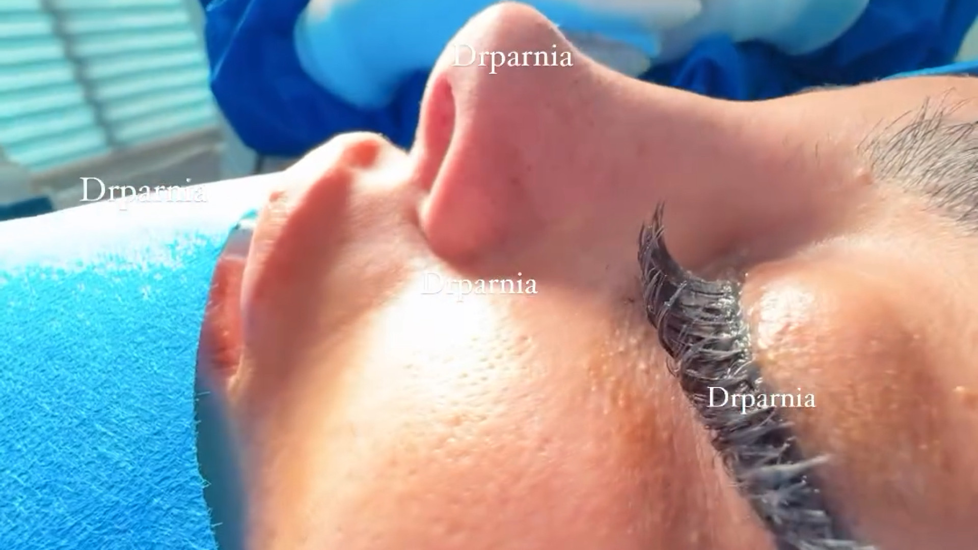 جراحی زیبایی بینی دکتر رفیع پرنیا فوق تخصص پلاستیک