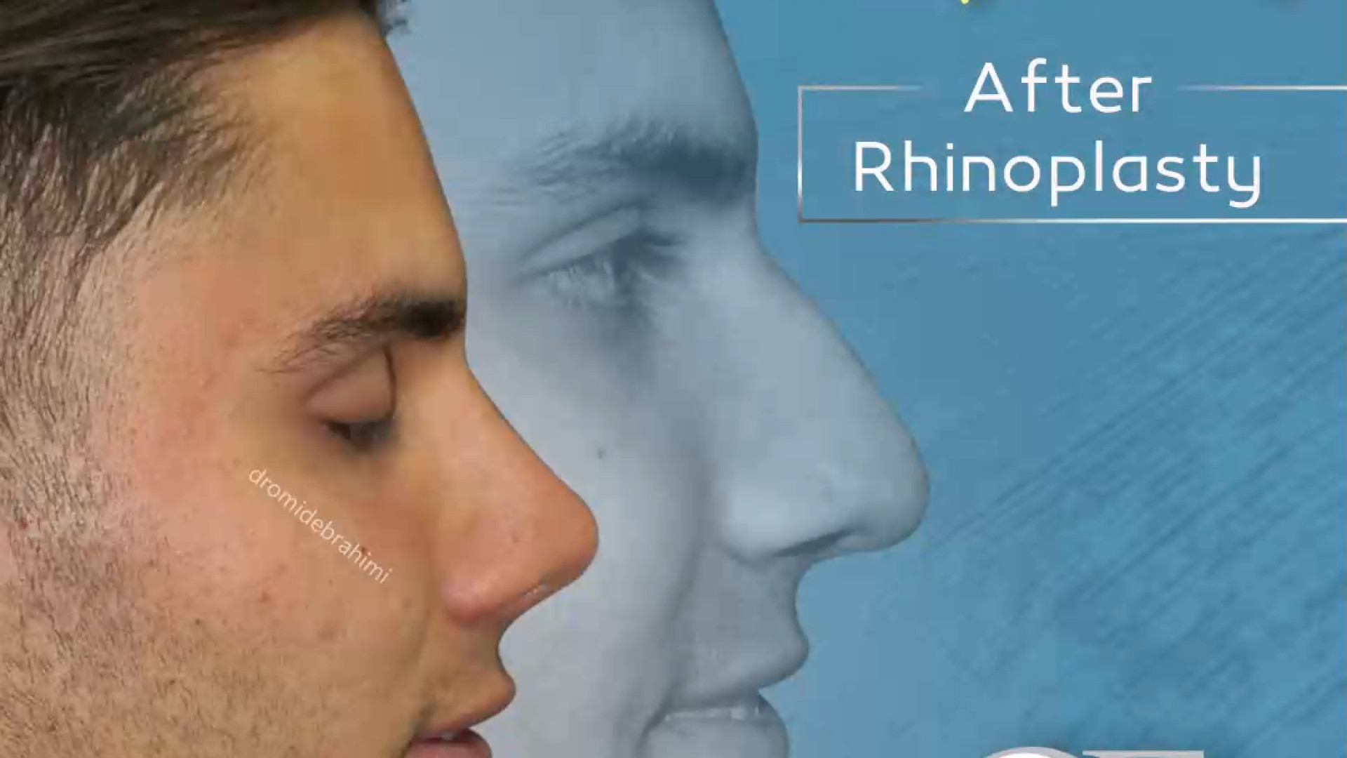 رضایتمندی بعد از جراحی بینی طبیعی مردانه توسط دکتر امید ابراهیمی دکتر امید ابراهیمی