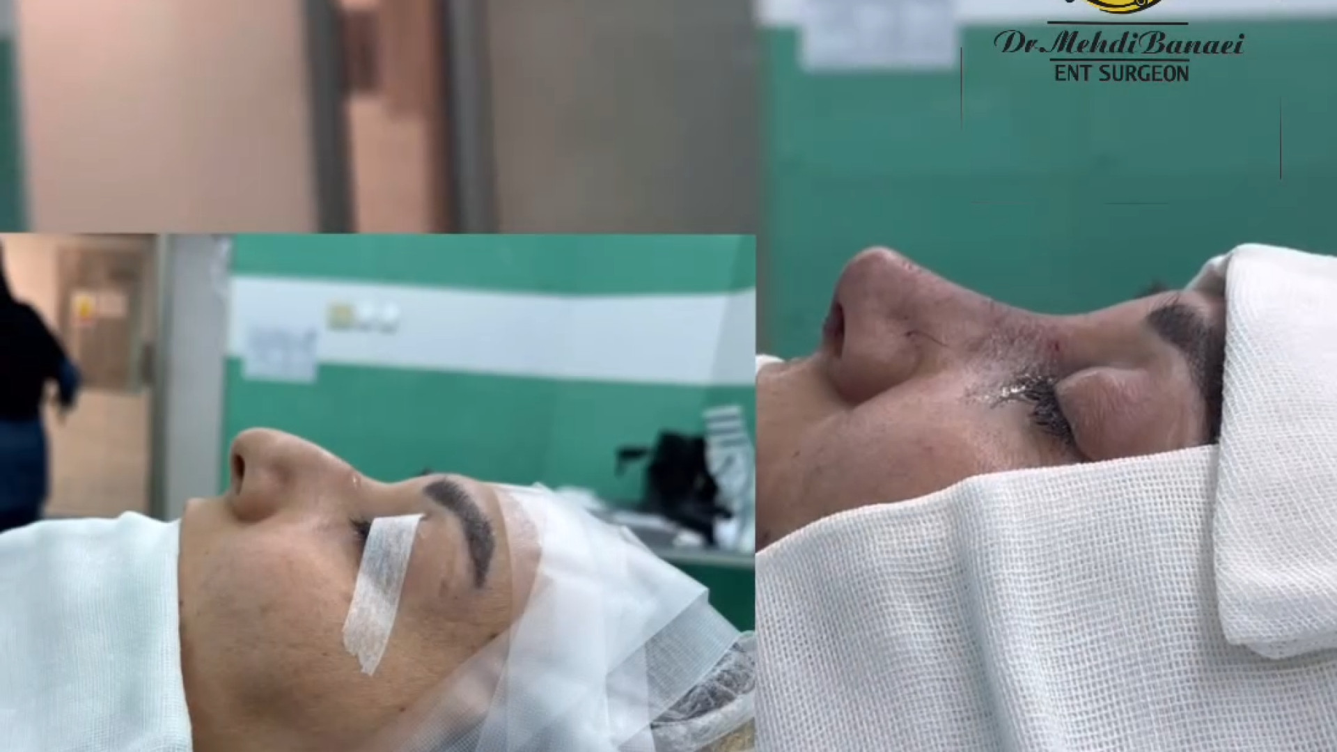 نگاهی به قبل و بعد از عمل بینی