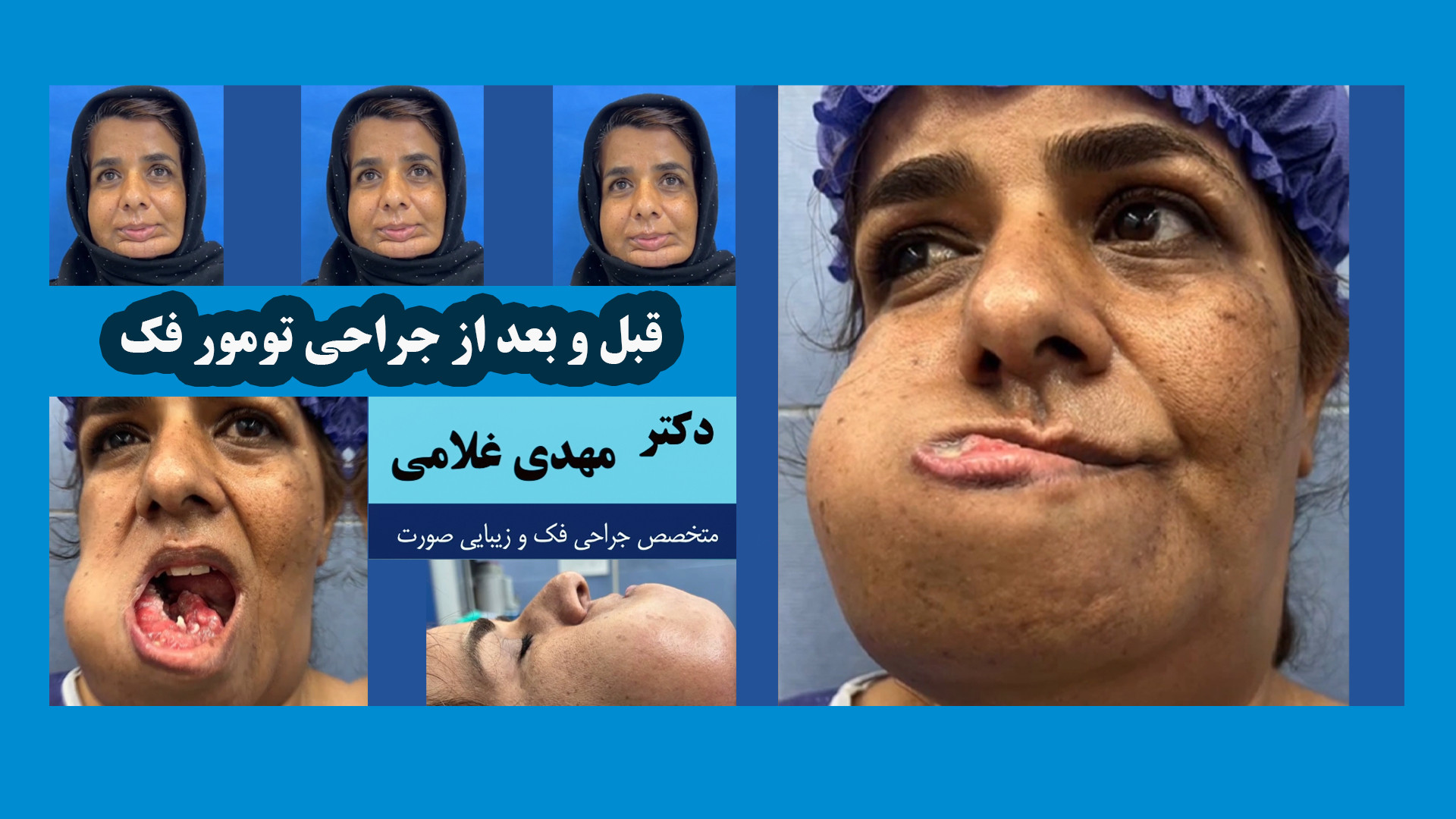 قبل و بعد از جراحی تومور فک در مشهد دکتر مهدی غلامی