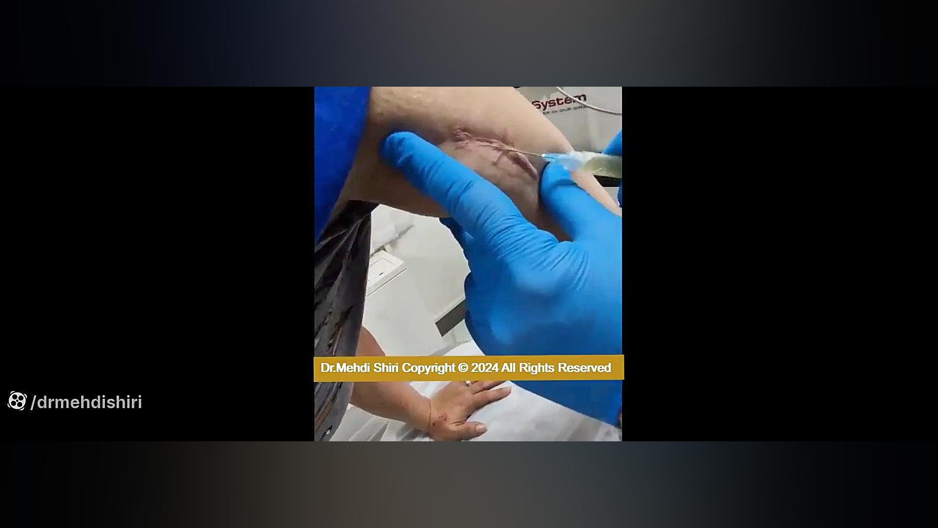 پی ار پی اسکار و گوشت اضافه کلینیک دکتر مهدی شیری