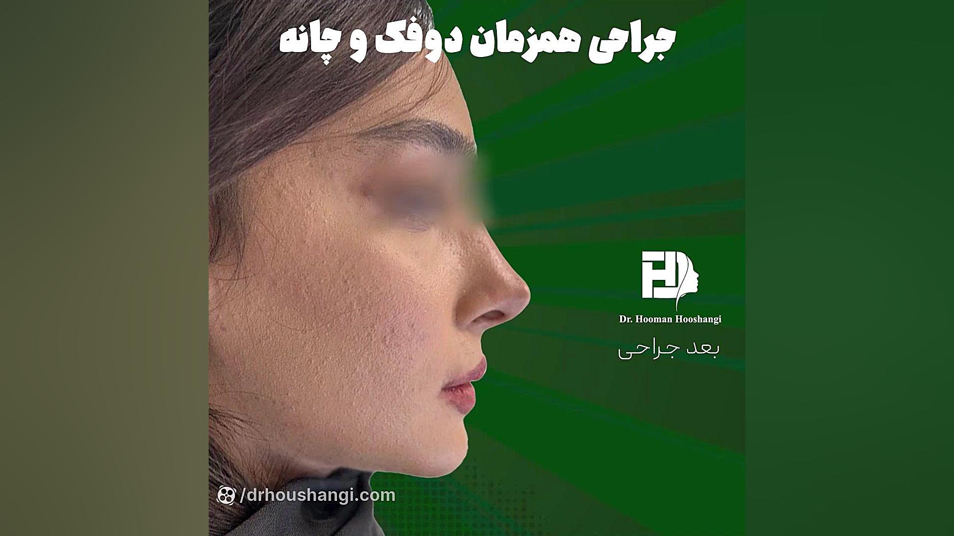 فیلم تغییرات چهره بعد از جراحی فک و صورت ANA