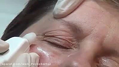 درمان افتادگی پلک بدون جراحی بیماری پیرفیریک نوروپاتی