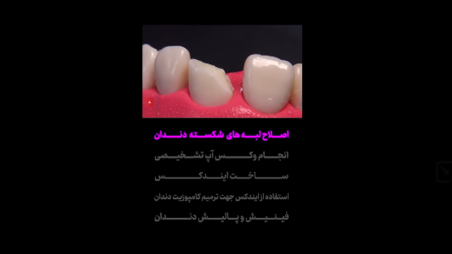 شکستگی لبه‌های دندان دکتر امین جباری