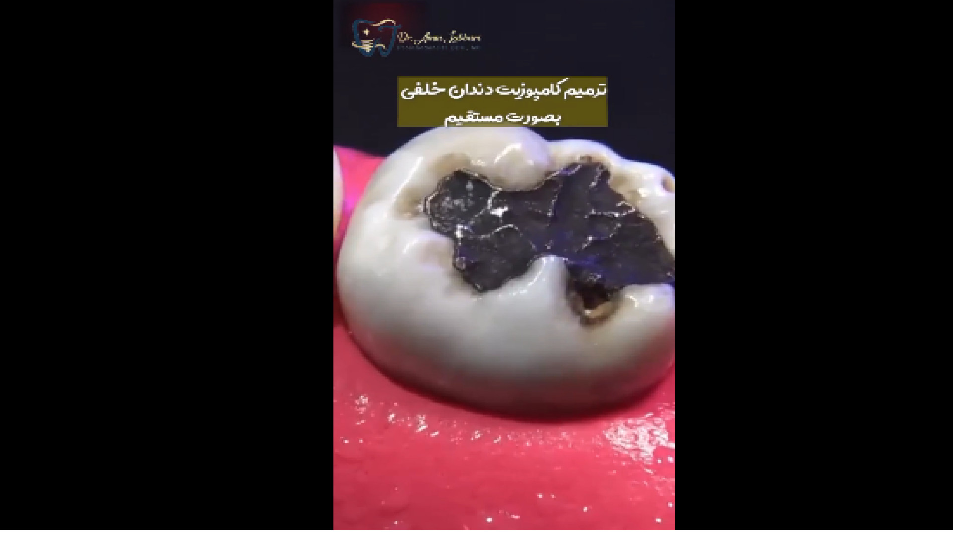 ترمیم کامپوزیت دندان‌ خلفی دکتر امین جباری