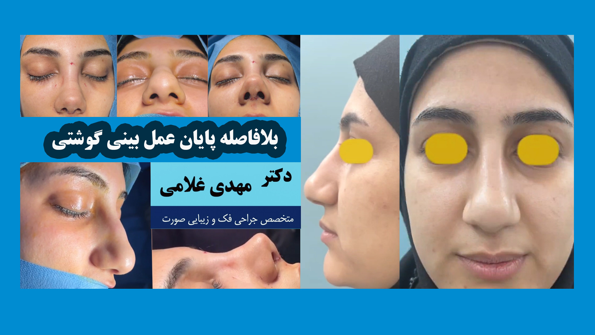 بلافاصله بعد از پایان جراحی بینی گوشتی در مشهد دکتر مهدی غلامی