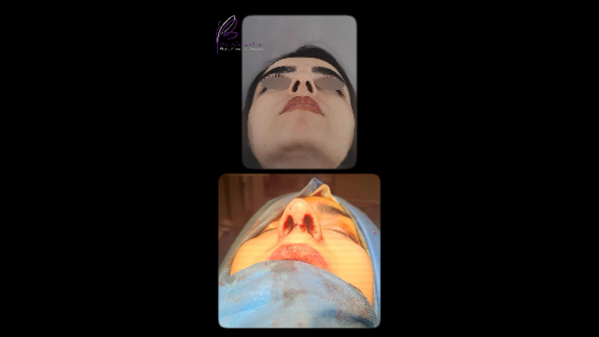 نمونه ای دیگر از جراحی زیبایی بینی دکتر کامران بابایی