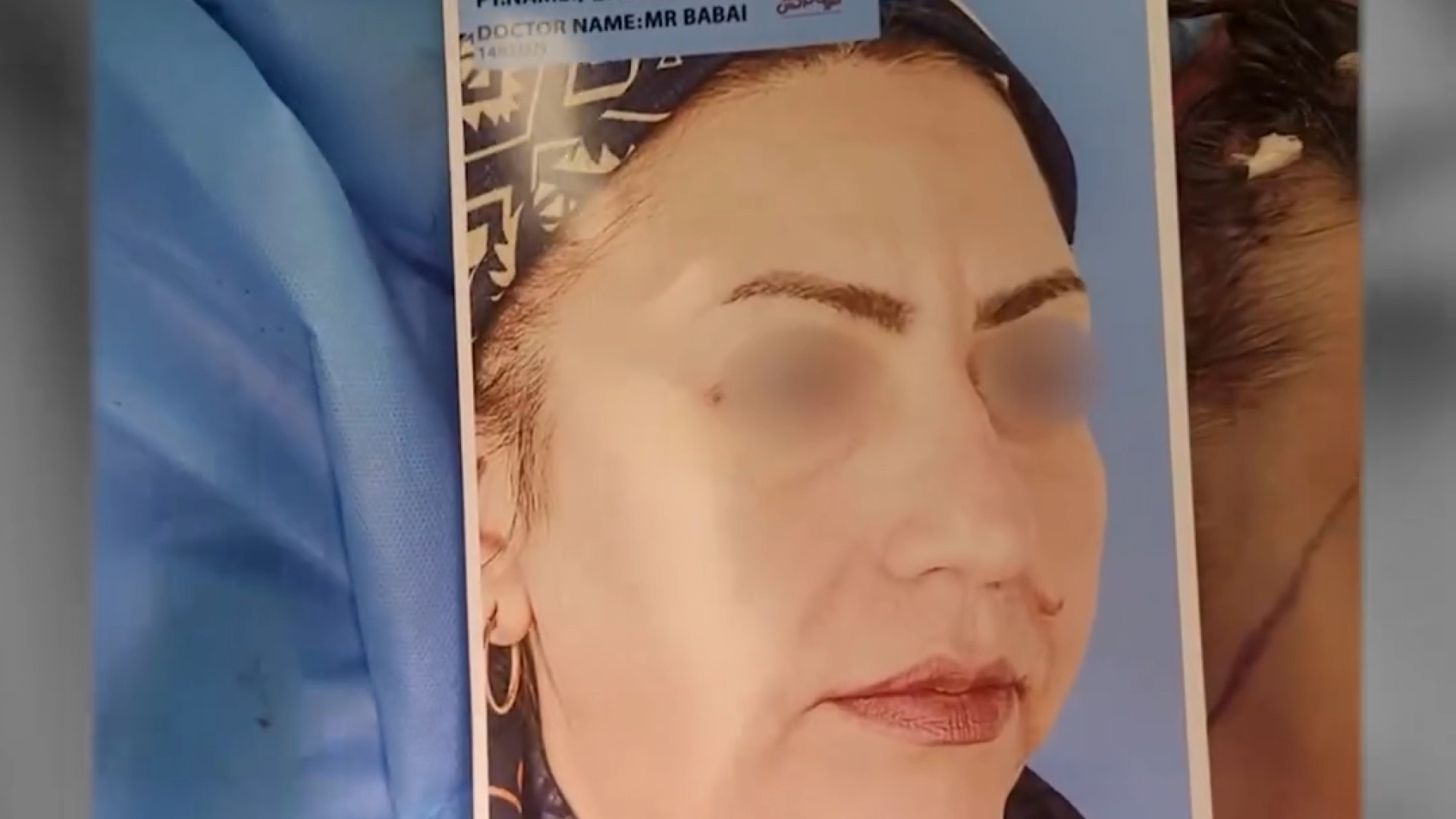 لیفت آندوسکوپی پیشانی دکتر کامران بابایی