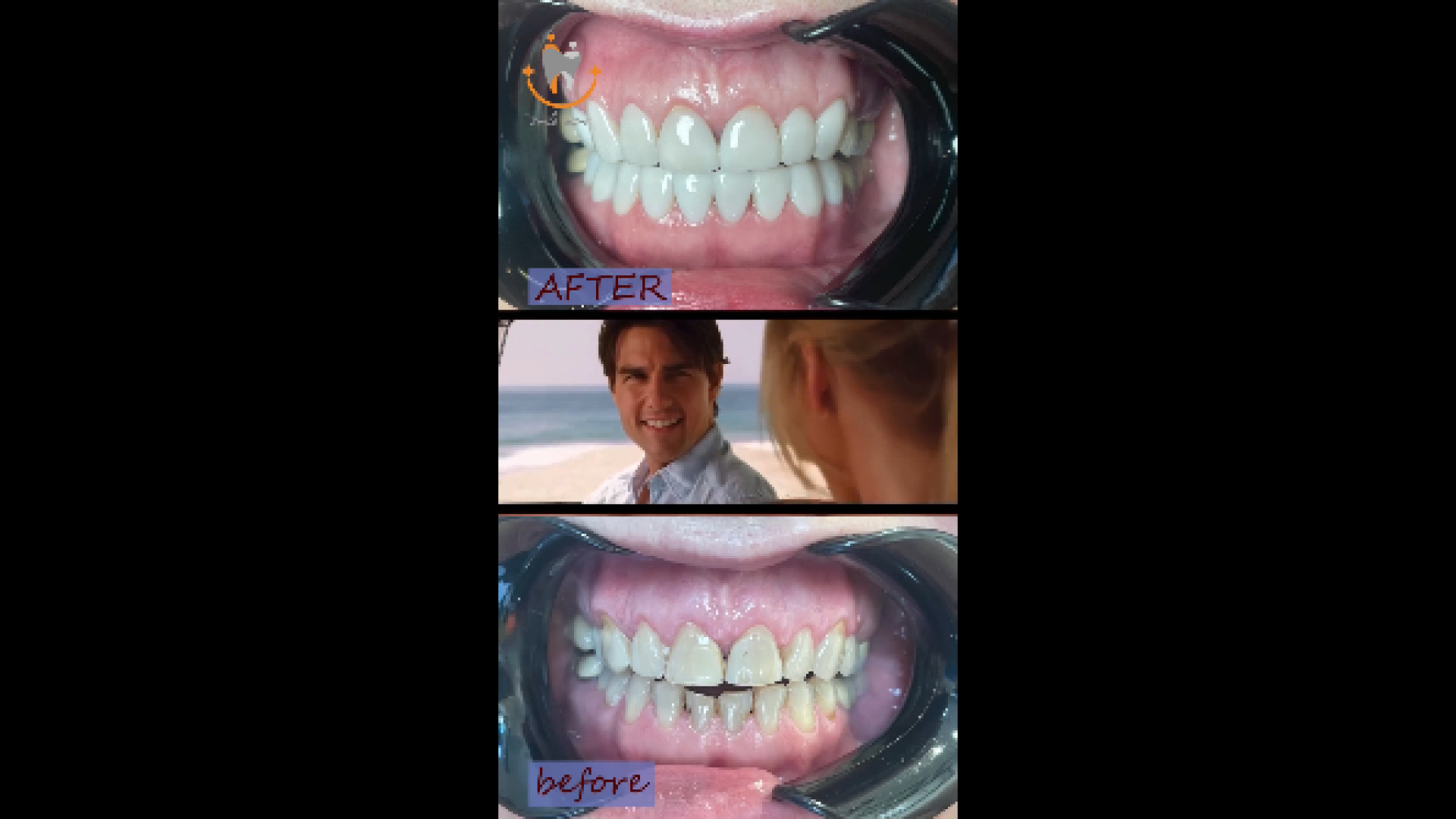 نمونه کار کامپوزیت دکتر سیمین برنگی | Dr Simin Berangi