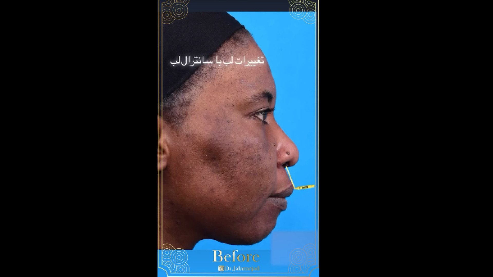 لیفت سانترال لب دکتر بابک جعفرنژاد