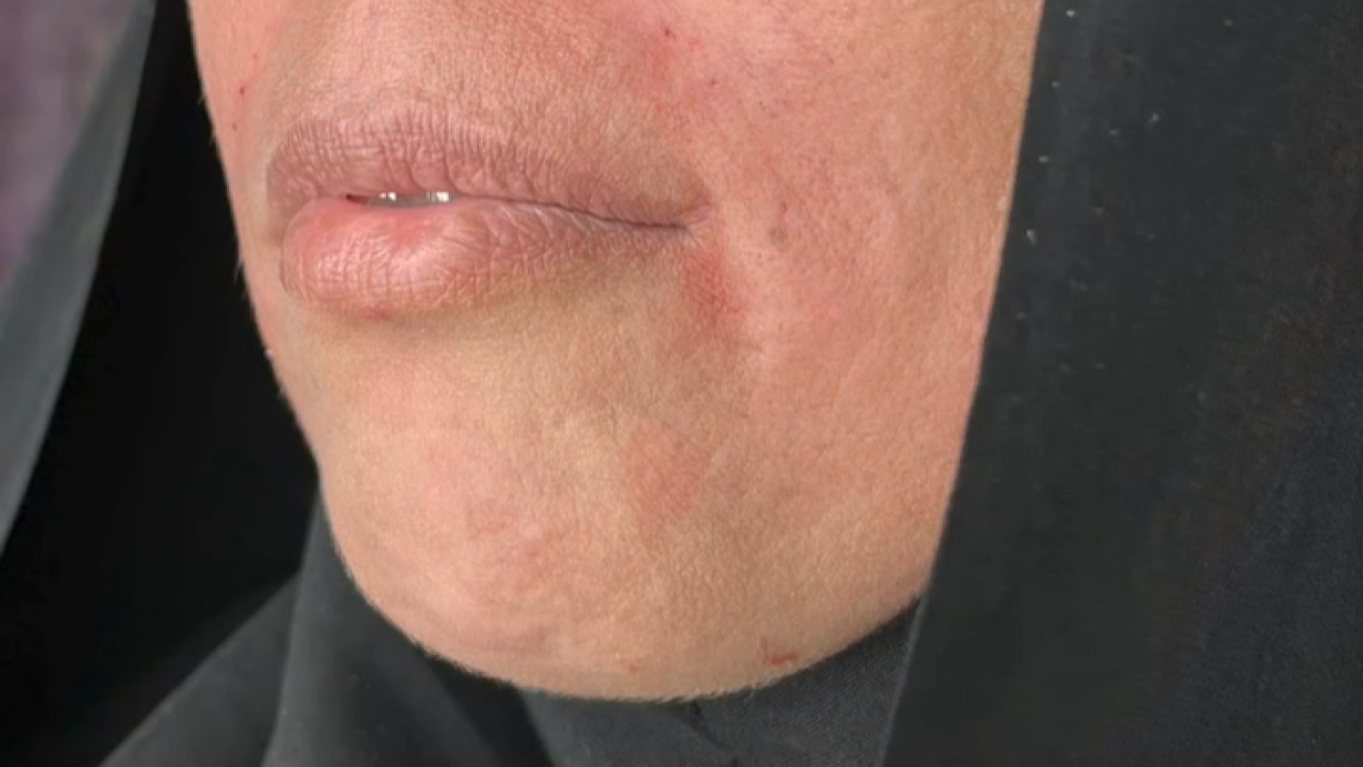 نمونه کار فیلر خط خنده دکتر صدیقه نائیجی | متخصص پوست و مو در قم