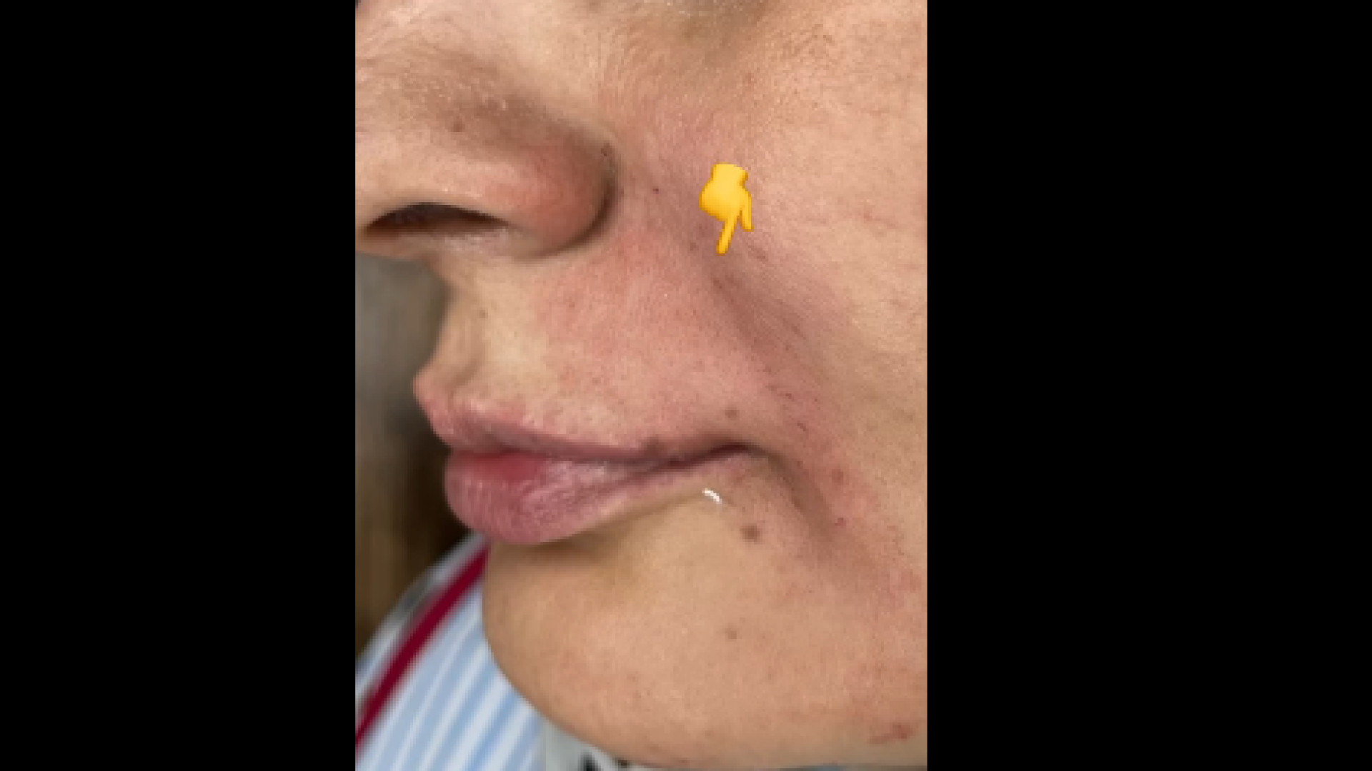 نمونه کار فیلر خط خنده دکتر صدیقه نائیجی | متخصص پوست و مو در قم