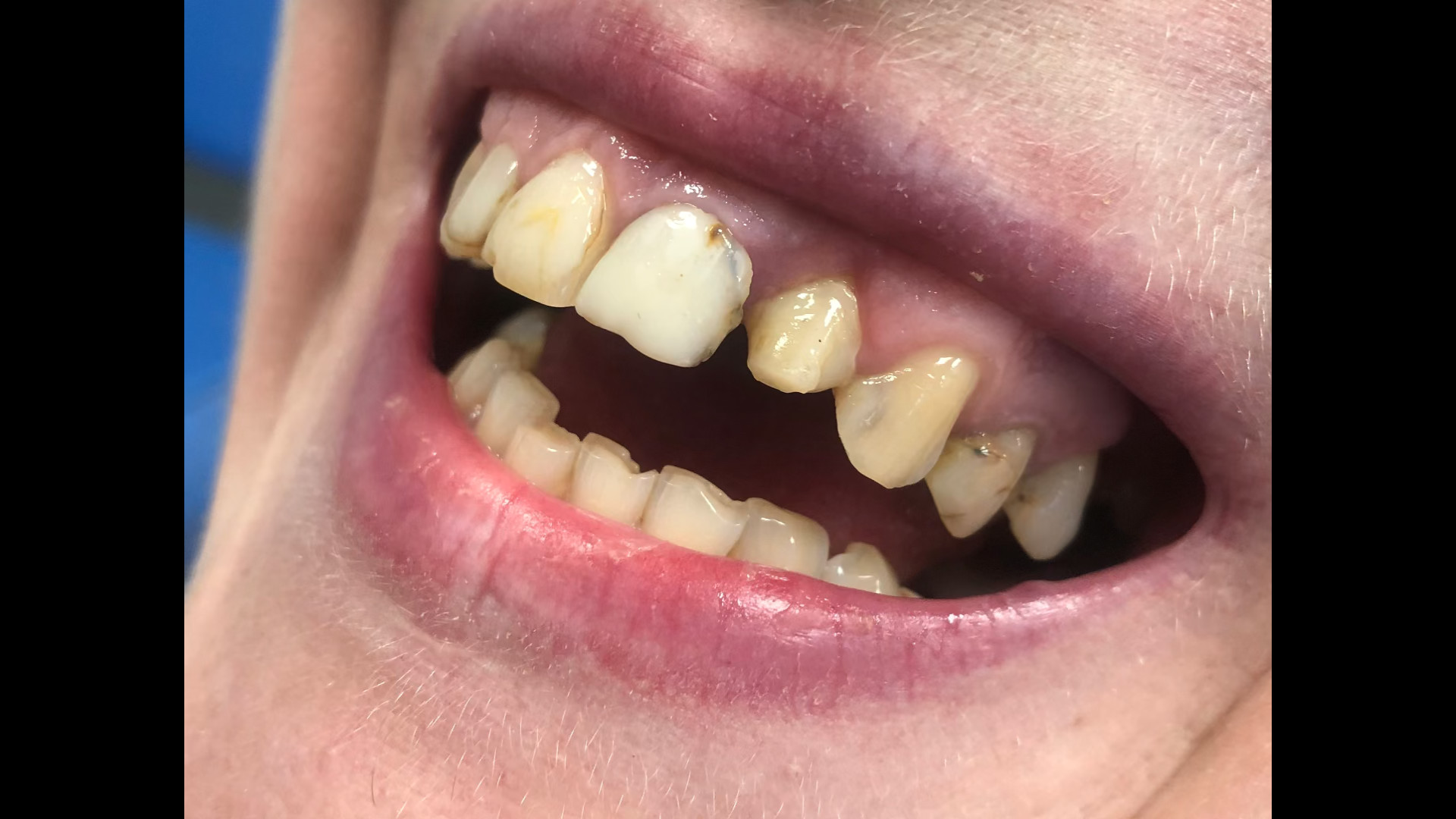 اصلاح خط لبخند همراه با جراحی فک بالا . E max PVRژنتیک پزشکی پیشرفته
