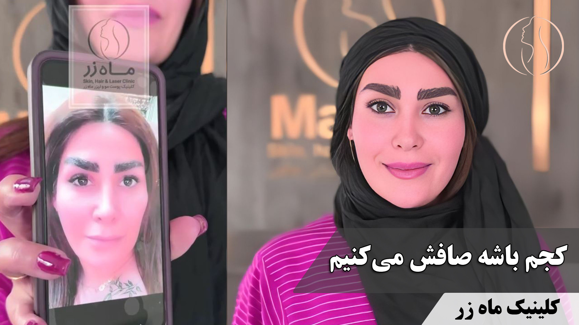 چرا بهترین انتخاب تزریق چربیه؟ ( کلینیک زیبایی ماه زر ) هایپوپاراتیروئیدیسم