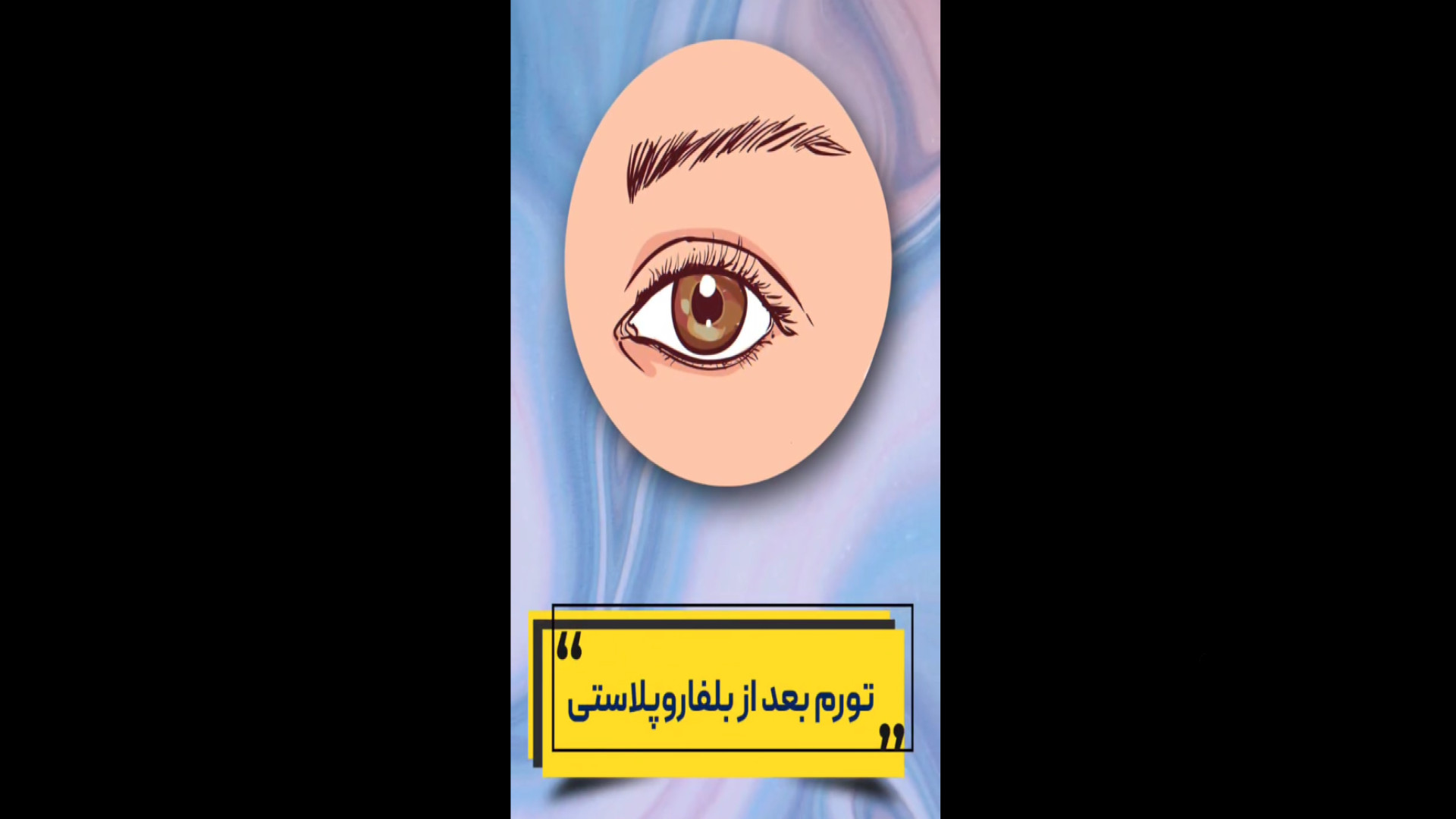 ورم بعد از بلفاروپلاستی دکتر خشایار سنجری متخصص جراحی جنرال و زیبایی