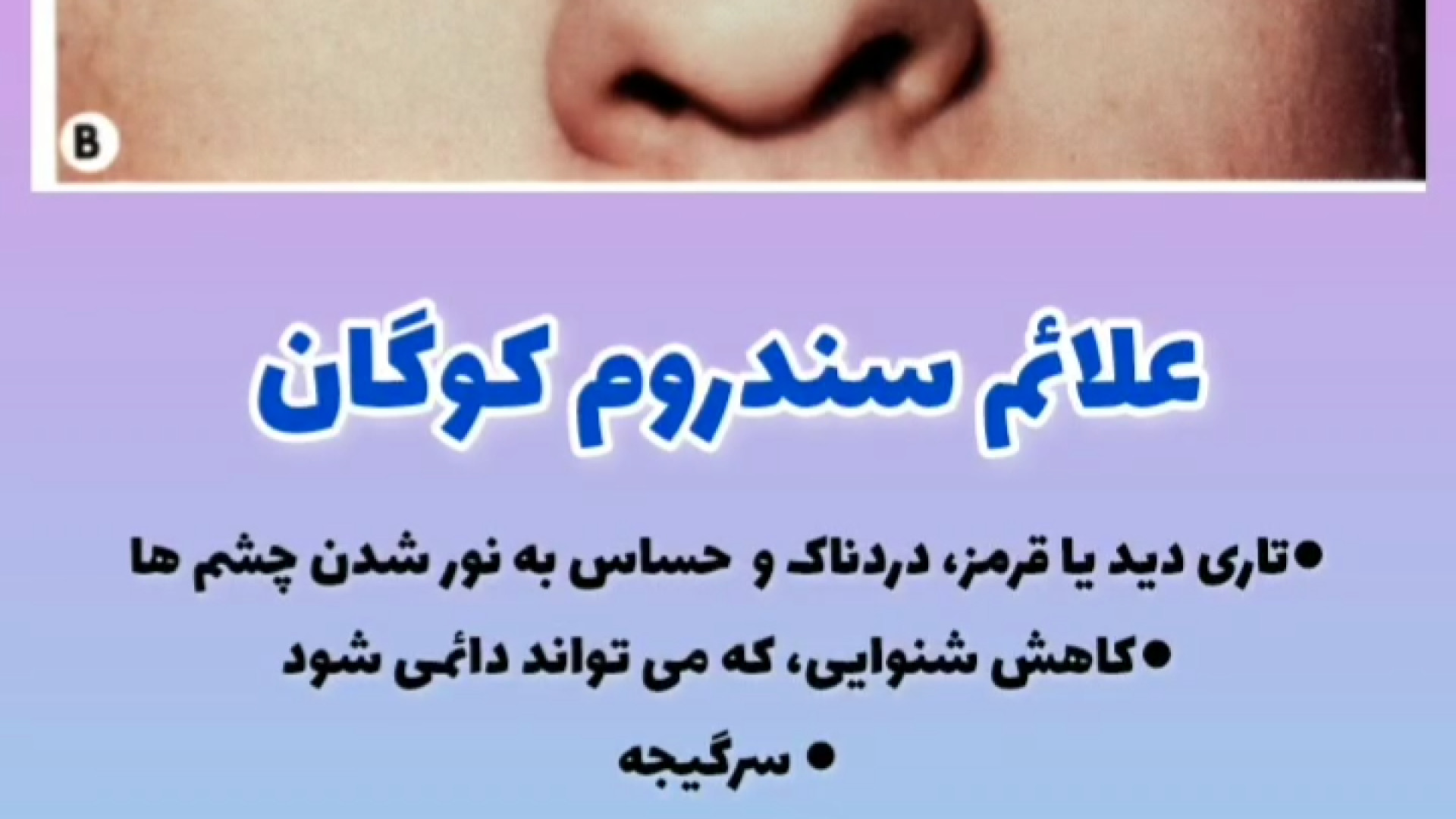 علائم سندروم کوگان جراحی زیبایی پلک