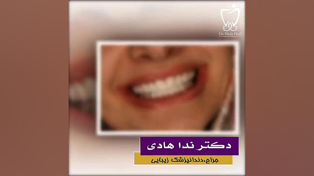 نمونه کار دکتر ندا هادی دکتر ندا هادی-دندانپزشک زیبایی