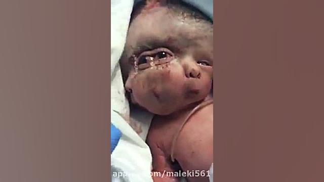 نوزاد به دنیا امده در یکی از بیمارستان های تهران با سه صورت و ... .baby face لیزر مو
