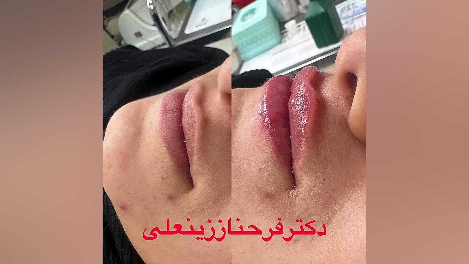 تزریق نیم سی سی ژل با متد روسی به لب دکتر فرحناز زینعلی - متخصص پوست، مو، زیبایی زنجان
