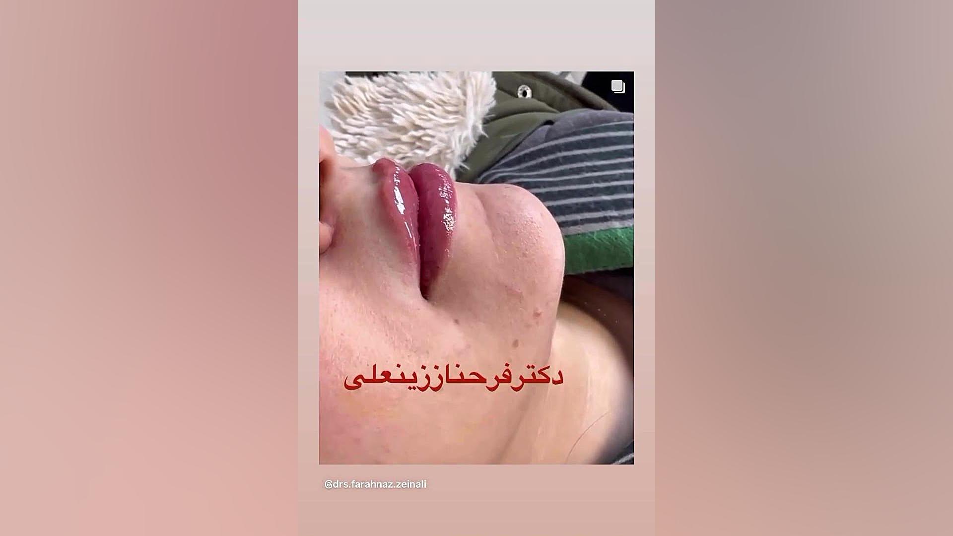 تزریق کمتر از یک سی سی ژل با متد روسی به لب دکتر فرحناز زینعلی - متخصص پوست، مو، زیبایی زنجان